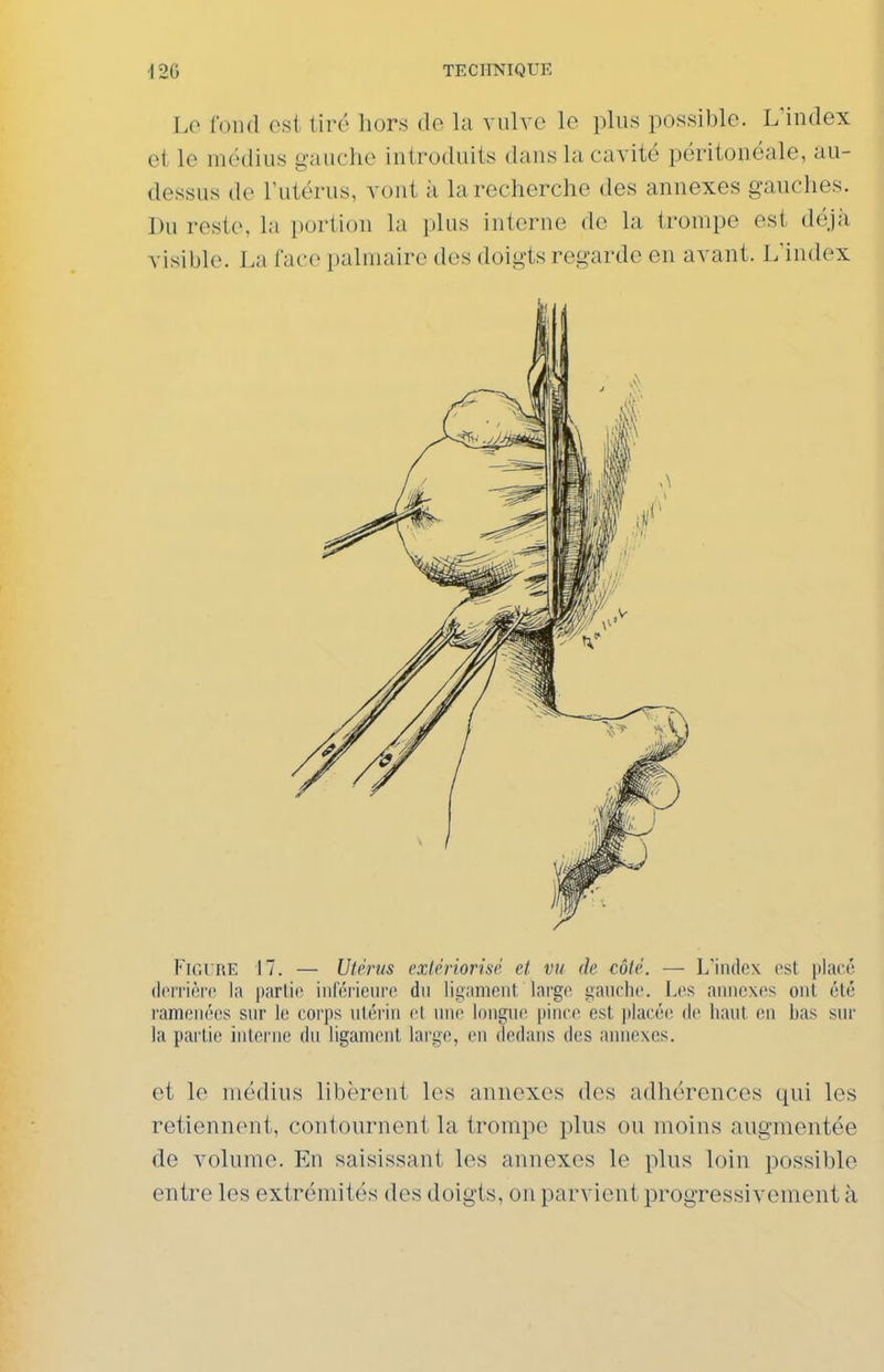 Le fond est tiré hors de la vulve le plus possible. LMndex et le médius gauche introduits dans la cavité péritonéale, au- dessus de l'utérus, vont à la recherche des annexes gauches. Du reste, la portion la i)lus interne de la trompe est déjà visible. La face palmaire des doigts regarde en avant. L'index Figure 17. — Utérus exlériorhé ei vu (h côté. — L'index est placé (lorrière la partie inférieure dn ligament large gauche. Les annexes ont été ramenées snr le corps utérin et une longue pince est jilacée de liant en l)as sur la partie interne du ligament large, en dedans des annexes. et le médius libèrent les annexes des adhérences qui les retiennent, contournent la trompe plus ou moins augmentée de volume. En saisissant les annexes le plus loin possible entre les extrémités des doigts, on parvient progressivement à