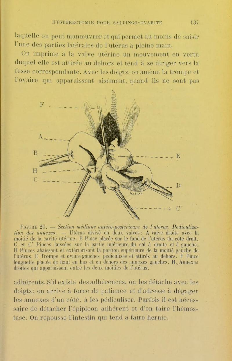 latiucUc on niaïKiMivrcr (>( ([ui [XM-inci du moins dv saisir ruuo (les i)arli('s latérales di» I iiUm-us ;i pleine main. (Ml ini[)rinîe à la valve iiU'i'ine un mouvement en vei'tu (liu[uel elle est atlinv^ au deliors el leiid h se dirii^'er V(>rs la fesse eorrespondante. Avec les doij^ls, on amène la trompe et Tovaire (|ui apparaissent aisément, quand ils ne sont pas l' iCil UK ^(1. — Scclioii iiii'iliuni' (tnlcro-postcricuir. de l'nlcnis. Prdicnlisn- lion di's anni'xcs. — Utérus divisé en deux valves : A valve droite avee la moitié de la eavité ulérine. H l'iiire placée sur le Ibiid de rutériis du côté droit. (1 et C Pinces laissées siu' la partie inlérieiu'e du col à di'oite et à gauche. |) l'Inces abaissant et extériorisant la portion sii|téricure de la moitié gauche de l'utérus. K Trompe et ovaire gauches |)édicnlisés et attirés au dehors. V Pince longuette placée de liant en lias el en dehoi's des annexes gauches, il. Annexes droites qui a|)paraisseiit entre les deux moitiés de l'iitéiMis. adhérents. S'il existe des adhérences, on les détache avec les doigts; on arrive à force de patience et d'adresse à dégager les annexes d'un côté, à les pédiculiser. Parfois il est néces- saire de détacher l'épiploon adhérent et d'en faire riiémos- tase. On repousse l'intestin qui tend ii faire hernie.