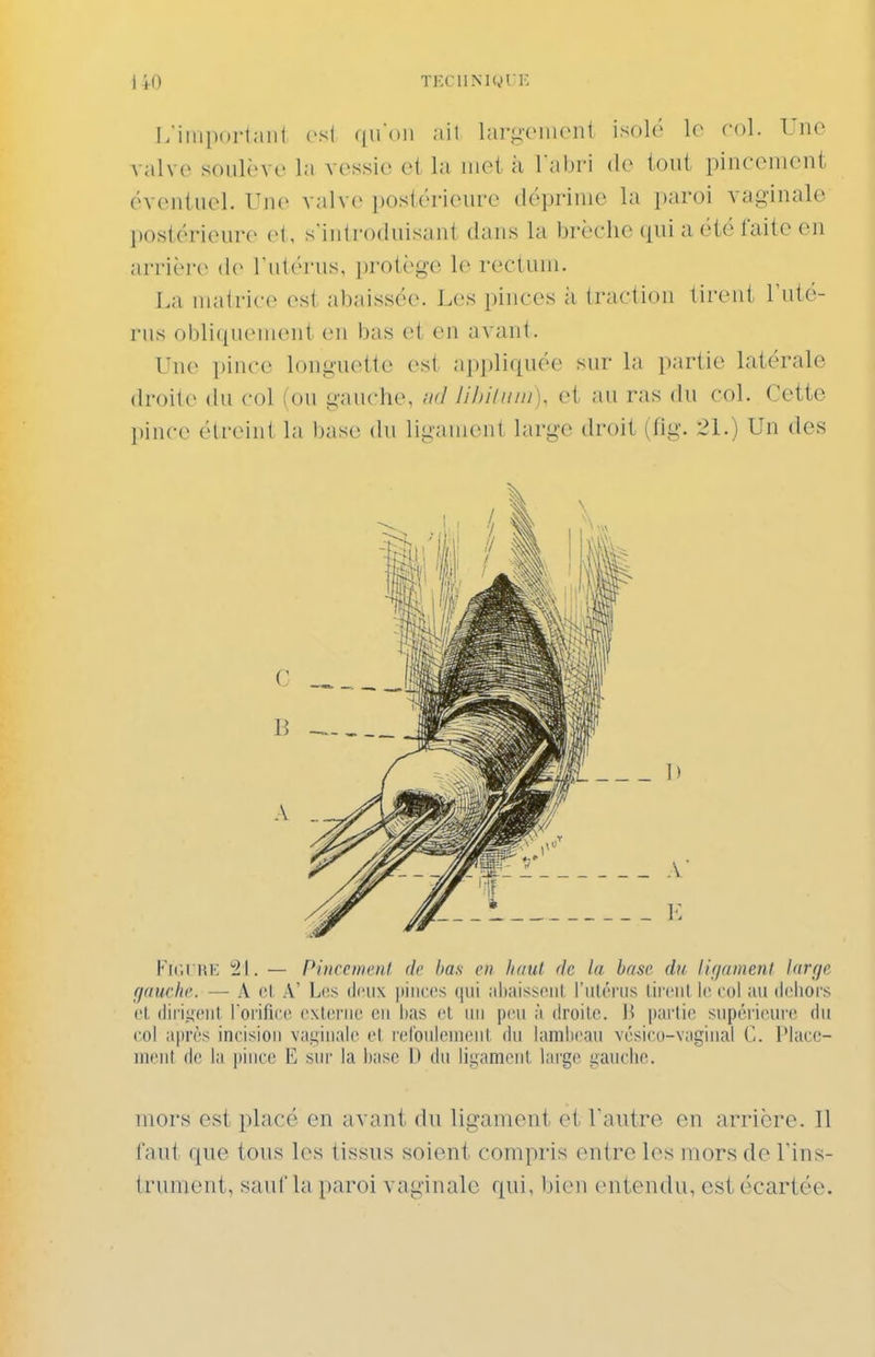 I/ilupurtaiil csl ail lai-j;'(Miioni isolé lo col. Une valve soulève la vcvssic ci la met k Tabri do ioui pinconient évonluel. Une valve i)oslôrieiirc déprime la paroi vaginale postérieure el, s introduisaut dans la brèche qui a été faite en arrièi'(> de Tutéiais, [U'otège le recluni. I.a matrice est abaissée. Les pinces à traction tirent Tuté- rus obliquement eu bas et en avant. Une pince longuette est appliquée sur la partie latérale droite du col (ou gauche, nd lihiliiiii). et au ras du col. Cette pince élreint la base du ligauient large droit (fig. 21.) Un des Kk.i he 21. — Pincenicni de bas en haut de la base du lifjainent larfjc gauclw. — A ol .\' Les deux pinces qui jtliaisseiil, l'ulénis lirciil le col iiii dehors et. diiii^eiil. rorifice externe en bas et un peu ;i droite, h pai'tie supérieure du col ;i|ir('s incision va.L;inale el l'elbulemenl du lambeau vésicu-vaginal C. IMacc- iiient de la pince E sur la i)ase t) du lii^amcnt large gauclic. mors est placé en avant du ligament et Vautre en arrière. Il faut que tous les tissus soient compris entre les mors de Tins- trumcnt, sauf la paroi vaginale qui, bieu entendu, est écartée.