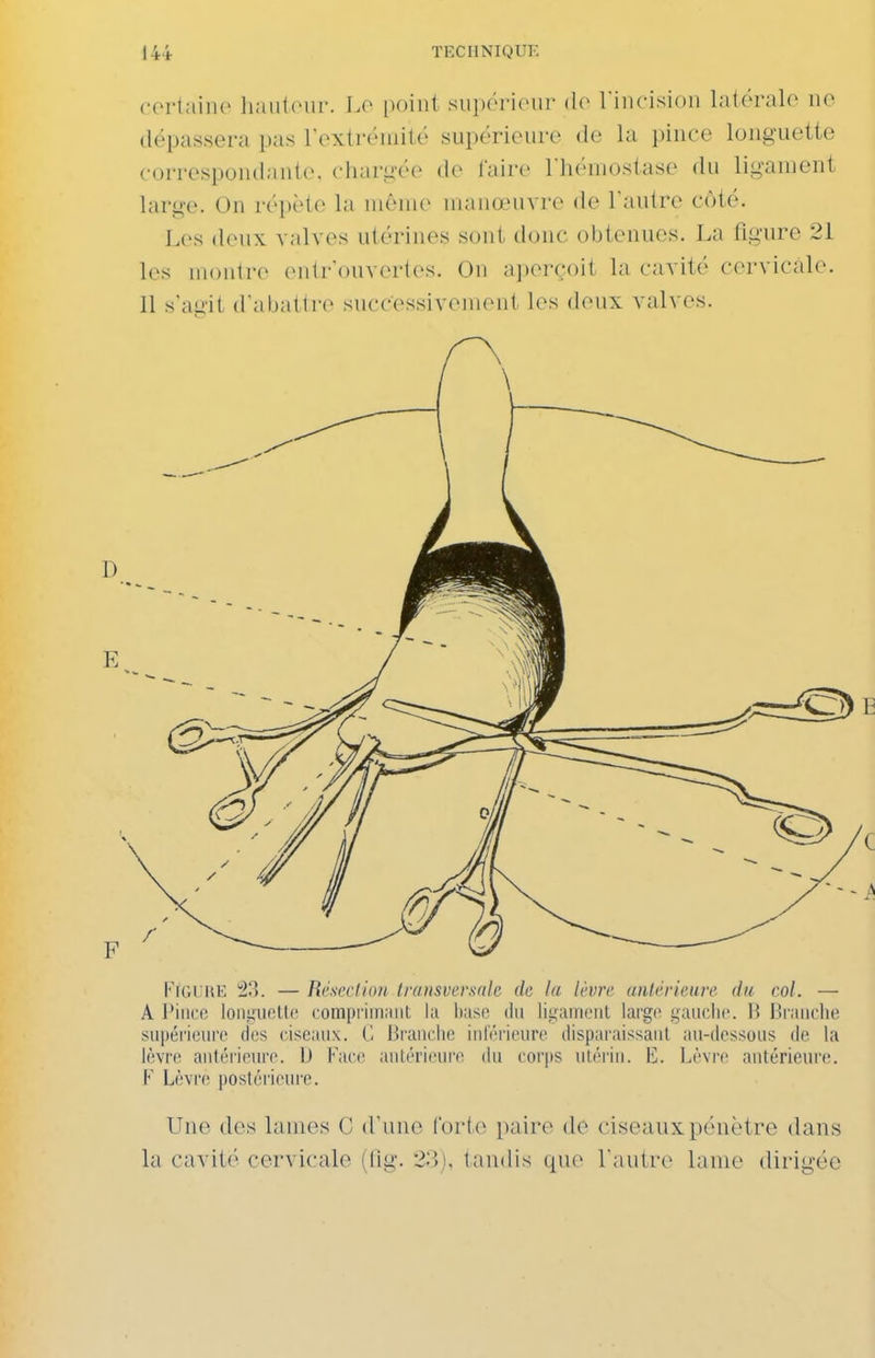 certaine liaufem-. Le point sn])éi'ienr de rinrision latérale ne dépassera pas l'extrémité supéricnre de la pince longuette correspondante, chari;ée de l'aire riiéniostase du lig-anient larg-e. On réjjète la même manœnvrc de l'autre côté. Les deux valves utérines sont donc obtenues. La figure 21 les montre entr'onvertes. On aperçoit la cavité cervicale. Il s'agit d'abattre successivement les deux valves. l-'ic.l UE ^)>. — Rrscclion transversale de la lèvre antérieure du col. — A l*iiice ioiitiiKîllo compi im.uit l;i liase du ligament largo gauche. H Branche .su|)éri(!ure des ciseaux. (1 Branclie inférieure disparaissant an-dessous de la lèvre antérieure. D Face antérieure du corps ntéi'in. K. Lèvre antérieure. F Lèvre postérieure. Une des lames C d'une forte paire de ciseaux pénètre dans la cavité cervicale (fig. 2;l). tandis que l'autre lame dirigée
