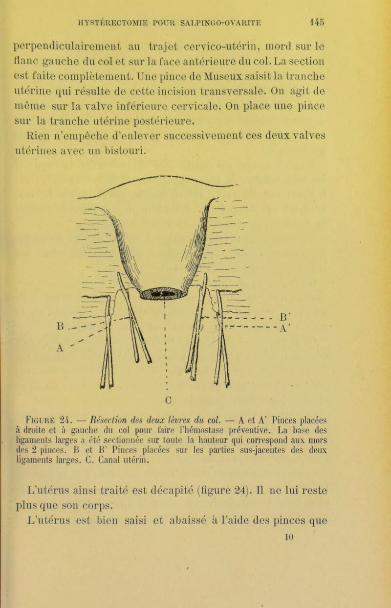 porpendiculaireiueiit au trajet cervico-utériu, mord sur lo (lanc gauche du col et sur la i'ace autérieure du col. La scctiou est faite complètement. Une pince de Museux saisit la tranche utérine qui résulte de cette incision transversale. On agit de même sur la valve inférieure cervicale. On place une pince sur la tranche utérine postérieure. Rien n'empêche d'enlever successivement ces deux valves utérines avec un bistouri. G Figure 2i. — Béseclion des deux lèvres du col. — A et A' Pinces placées à droite et à gaiiclie du col pour faire Tliémostase préventive. La hase des liiçaniunts larges a été sectionnée snr tonte la hauteur qui correspond aux iTiors des 1 pinces. B et B Pinces placées sur les parties sus-jacentes des deux ligaments larges. C. Canal utérin. L'utérus ainsi traité est décapité (figure 24). Il ne lui reste plus que son corps. L'utérus est bien saisi et abaissé à l'aide des pinces que 10