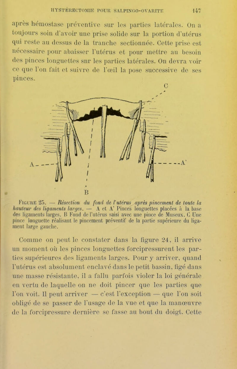après hémostase préventive sur les parties latérales. On a toujours soin d'avoir une prise solide sur la portion d'utérus qui reste au dessus de la tranche sectionnée. Cette prise est nécessaire pour abaisser l'utérus et pour mettre au besoin des pinces longuettes snr les parties latérales. On devra voir ce que Von (ait et suivre de l'œil la pose successive de ses pinces. C B Figure 25. — Résection du fond de l'utérus après pincement de toute la hauteur des ligaments lan/es. — A et A' Pinces longuettes placées à la base lies ligaments larges. W Fond do l'utérus saisi avec une pince de Museux. C. Une pinci! longuette réalisant le pincement préventif de la partie supéri(!uro du liga- ment large gauche. Comme on peut le constater dans la figure 24, il arrive un moment où les pinces longuettes forcipressurent les par- ties supérieures dos ligaments larges. Pour y arriver, quand l'utérus est absolument enclavé dans le petit bassin, figé dans une masse résistante, il a fallu parfois violer la loi générale eu vertu de laquelle on ne doit pincer que les parties que l'on voit. Il peut arriver — c'est l'exception — que l'on soit obligé de se passer de Tusage de la vue et que la manœuvre de la forcipressure dernière se fasse au bout du doigt. Cette