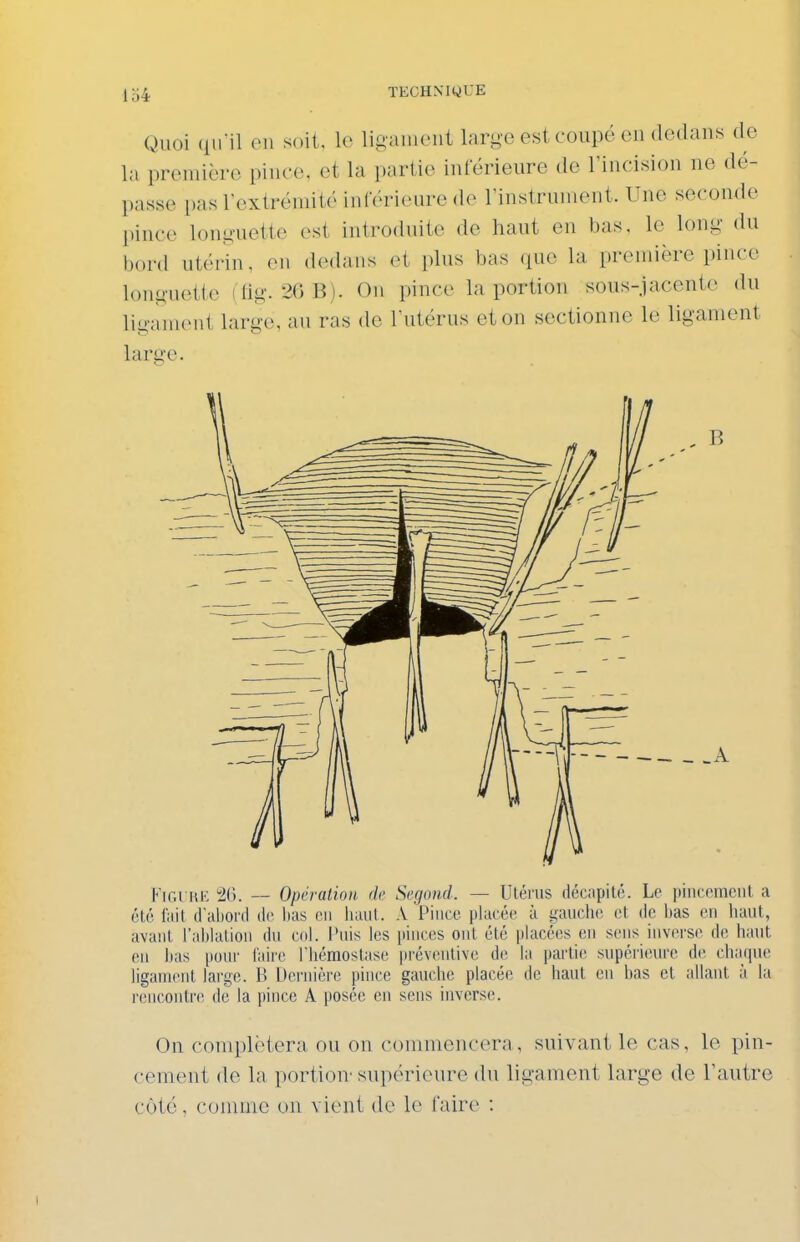Ib4 Quoi qu-il en soit, le ligament large est coupé en dedans de la première pince, et la partie inférieure de l'incision ne dé- passe pas l'extrémité inférieure de l'instrument. Une seconde pince longuette est introduite de haut en bas, le long du bord utérin, en dedans et plus bas que la prennère pince longuette ( tig. 26 B). On pince la portion sous-jacente du ligament large, au ras de l'utérus et on sectionne le ligament lartre. Figure 26. — Opération de Scgond. — TJlérus décapité. Le pincement a été fait d'aliortl ilc lias en luuil. A Pince placée à i,^anclie et de bas en haut, avant l'ablation du col. Puis les pinces ont été placées en sens inverse de haut eu bas pour faire fhéraostase préventive de la partie supérieure de chaque ligament large. B Dernière pince gauche placée de haut en bas et allant à la rencontre de la pince A posée en sens inverse. On complétera ou on commencera, suivant le cas, le pin- cement de la portion' supérieure du ligament large de l'autre côté, comme on vient de le faire : 1