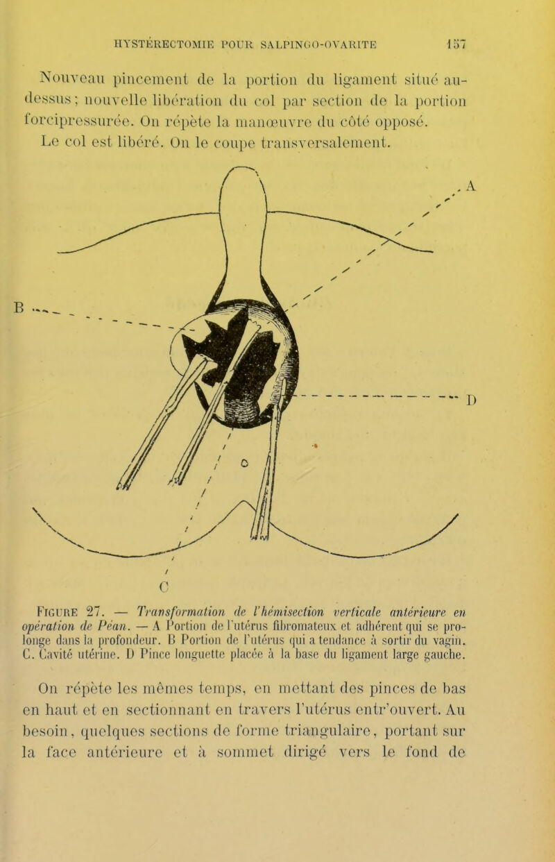 NoiiTeau pincement de la i)oriion du ligament situé au- dessus; nouvelle libération du col par section do la portion forciprossurée. On répète la manœuvre du côté opposé. Le col est libéré. On le coupe transversalement. 0 FifiURE 27. — Transformation de l'hhiiisedion verticale antérieure en opération de Péan. — A Portion de ruténis filjromaUiiix el. adhérent qui se pro- longe dans ia profondeur. B Portion de Tnlérus qui a tendance à sortir du vagin. C. Cavité utérine. D Pince longu(!tte placée à la base du ligament large gauche. On répète les mêmes temps, en mettant des pinces de bas en haut et en sectionnant en travers l'utérus entr'ouvert. Au besoin, quelques sections de forme triangulaire, portant sur la face antérieure et à sommet dirigé vers le fond de