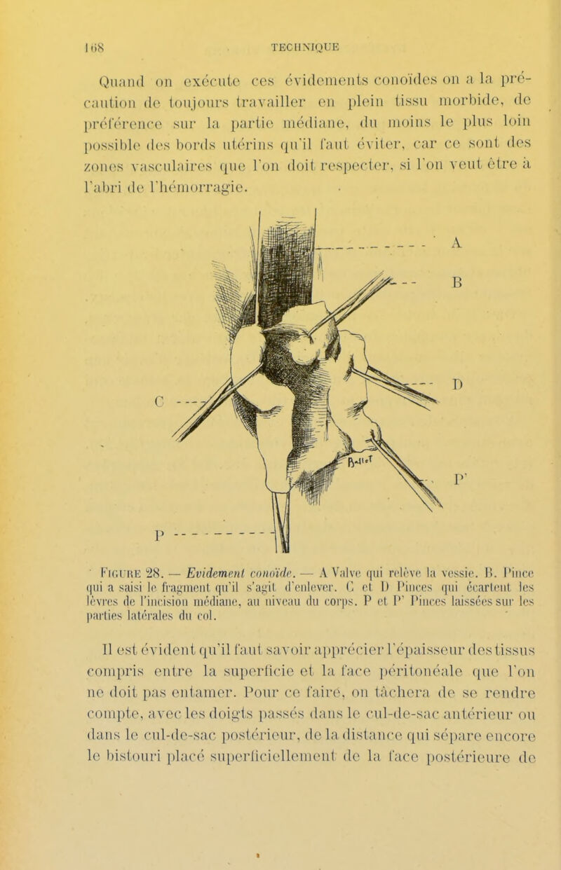 TECIIXIOUE Quand on exécute ces évidements conoïdes on a la pré- caution (1(^ toujours travailler en plein tissu morbide, de préférence sur la partie médiane, du moins le plus loin possil)le (les bords utérins qu'il faut éviter, car ce sont des zones vasculaires <|ue I on doit respecter, si l'on veut être à l'abri de l liéniorragie. Fici iUî 28. — Evidemenl conouh'. — A Valve qui relève la vessie. H. l'ince (|iii a saisi le frai;ineiil qu'il s'aiiil d'enlever. (î el 1) l'inces qui écarleut les lèvi-es (le l'incision in(kliau(!, au niveau du corjis. P et 1' l'inces laissées sur les parties latérales du col. Il est évident qu'il fa ut savoir apprécier l'épaisseur des tissus compris entre la superlicie et la face péritonéale que l'on ne doit pas entamer. Pour ce fairô, on tâchera de se rendre compte, avec les doig'ts j)assés dans le cul-de-sac antérieur ou dans le cnl-de-sac postérieur, de la distance qiu sépare encore le bistouri placé superliciellenienl de la face postérieure do