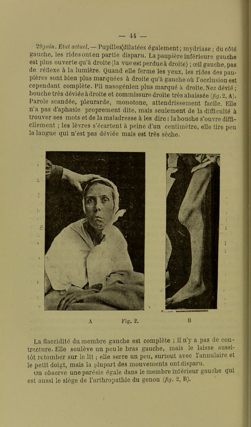 29^i{'m. Etat actuel. — Pupilles;dilatées également ; mydriase ; du côté gauche, les rides onten partie disparu. La paupière inférieure gauche est plus ouverte qu'à droite (la vue est perdueà droite) ; œil gauche, pas de réflexe à la lumière. Quand elle ferme les yeux, les rides des pau- pières sont bien plus marquées à droite qu'à gauche où l'occlusion est cependant complète. Pli nasogénien plus marqué à droite.Nez dévié; bouche très déviée à droite et commissure droite très abaissée {firj.2, A)'. Parole scandée, pleurarde, monotone, attendrissement facile. Elle n'a pas d'aphasie proprement dite, mais seulement de la difficulté à trouver ses mots et de la maladresse à les dire : la bouche s'ouvre diffi- cilement ; les lèvres s'écartent à peine d'un centimètre, elle tire peu la langue qui n'est pas déviée mais est très sèche. A Fig. 2. B La flaccidité du membre gauche est complète ; il n'y a pas de con- tracture. Elle soulève un peu le bras gauche, mais le laisse aussi- tôt retomber sur le lit ; elle serre un peu, surtout avec l'annulaire et le petit doigt, mais la plupart des mouvements ont disparu. On observe une parésie égale dans le membre inférieur gauche qui est aussi le siège de l'arthropathie du genou {fig. 2, B).