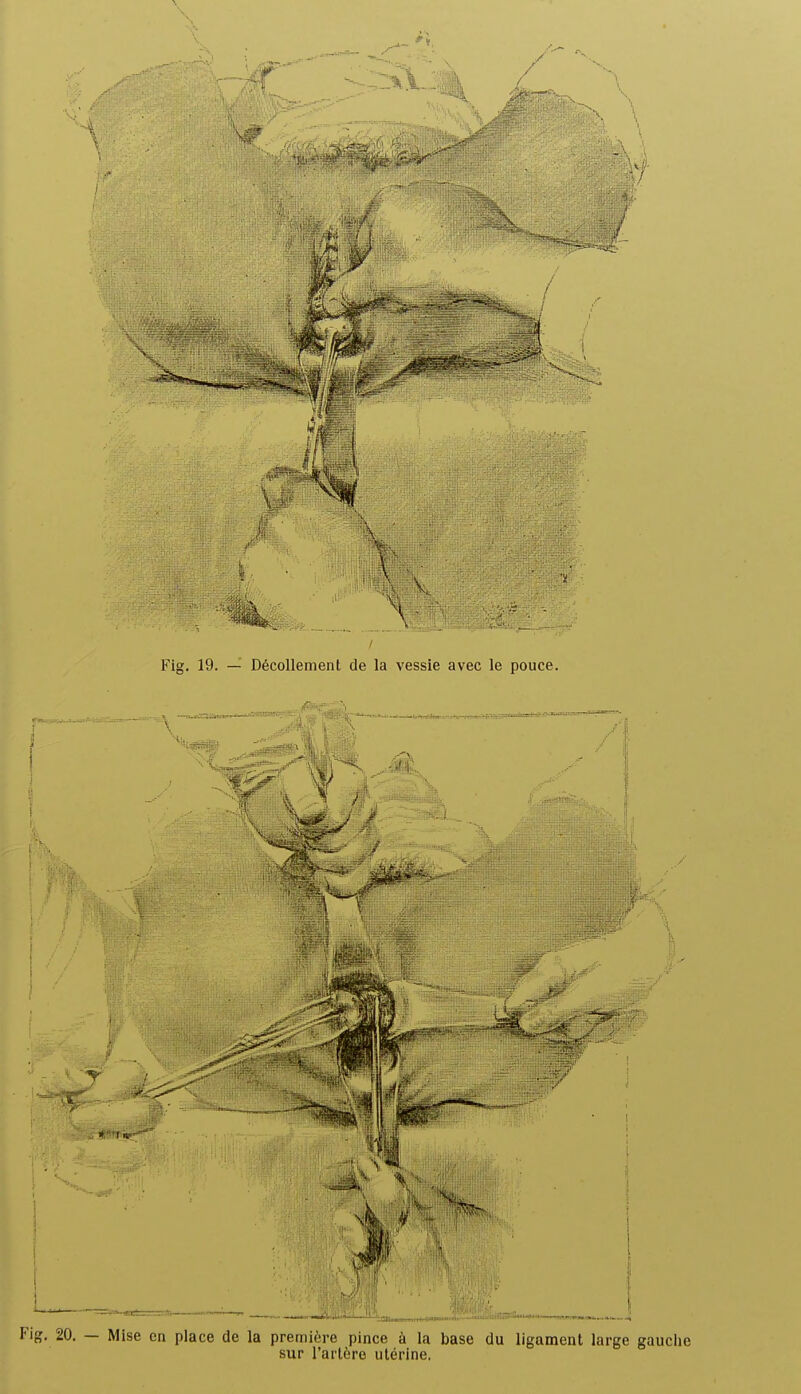 Fig. 19. — Décollement de la vessie avec le pouce. Fig. 20. — Mise en place de la première pince à la base du ligament large gauche sur l'artère utérine.