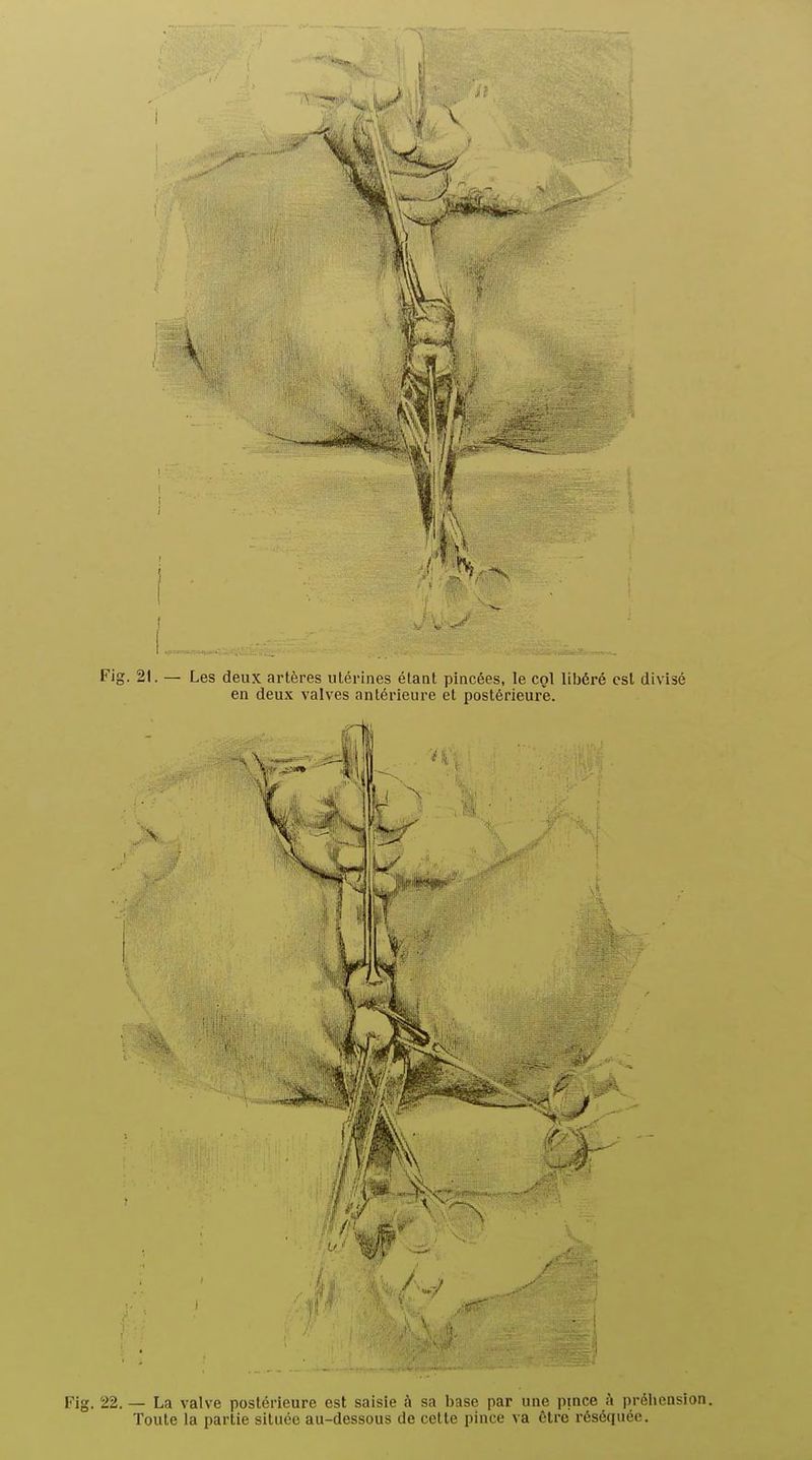 Fig. 22.— La valve postérieure est saisie à sa base par une pince à préiicnsion. Toute la partie située au-dessous de cette pince va être réséquée.