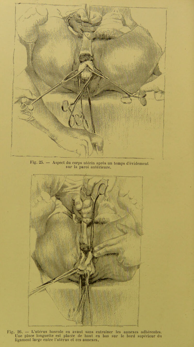 Fig. 25. — Aspect du corps ulérin après un temps d'éviclement sur la paroi antérieure. i'ig. 26. — L'utérus bascule en avant sans entraîner les annexes adiiérentes. Une pince longuelle est placée de liaut en bas sur le bord supérieur du liganieiil large entre l'utérus et ces annexes.