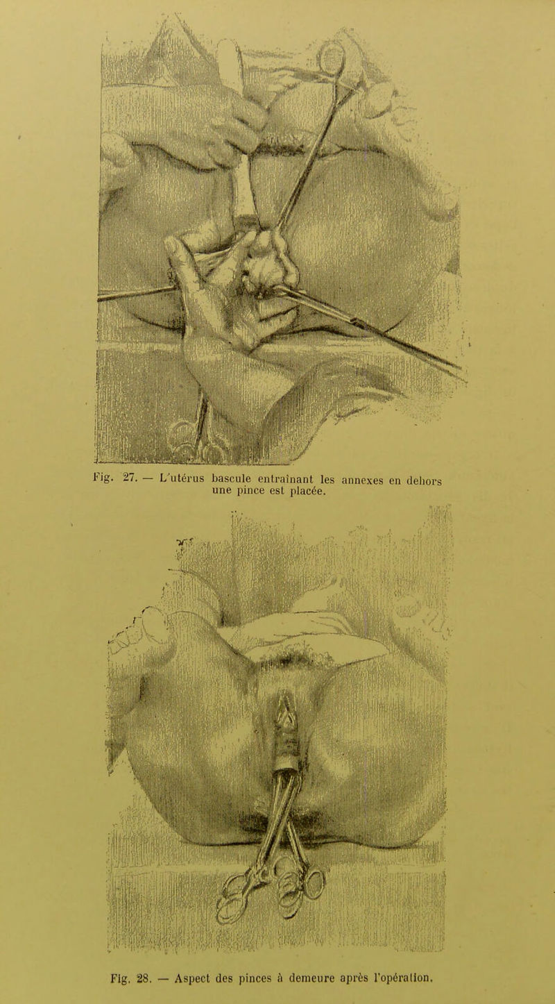 Fig. 28. — Aspect des pinces à demeure après l'opérallon.