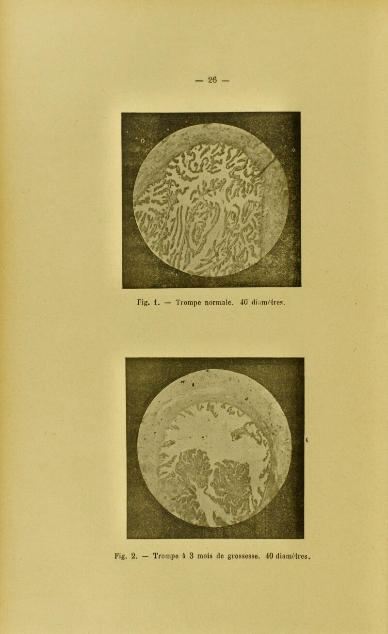 Fig. 1. — Trompe normale, 40 diMnK'tres, Fig. 2. Trompe à 3 mois de grossesse. 40 diamùtres.