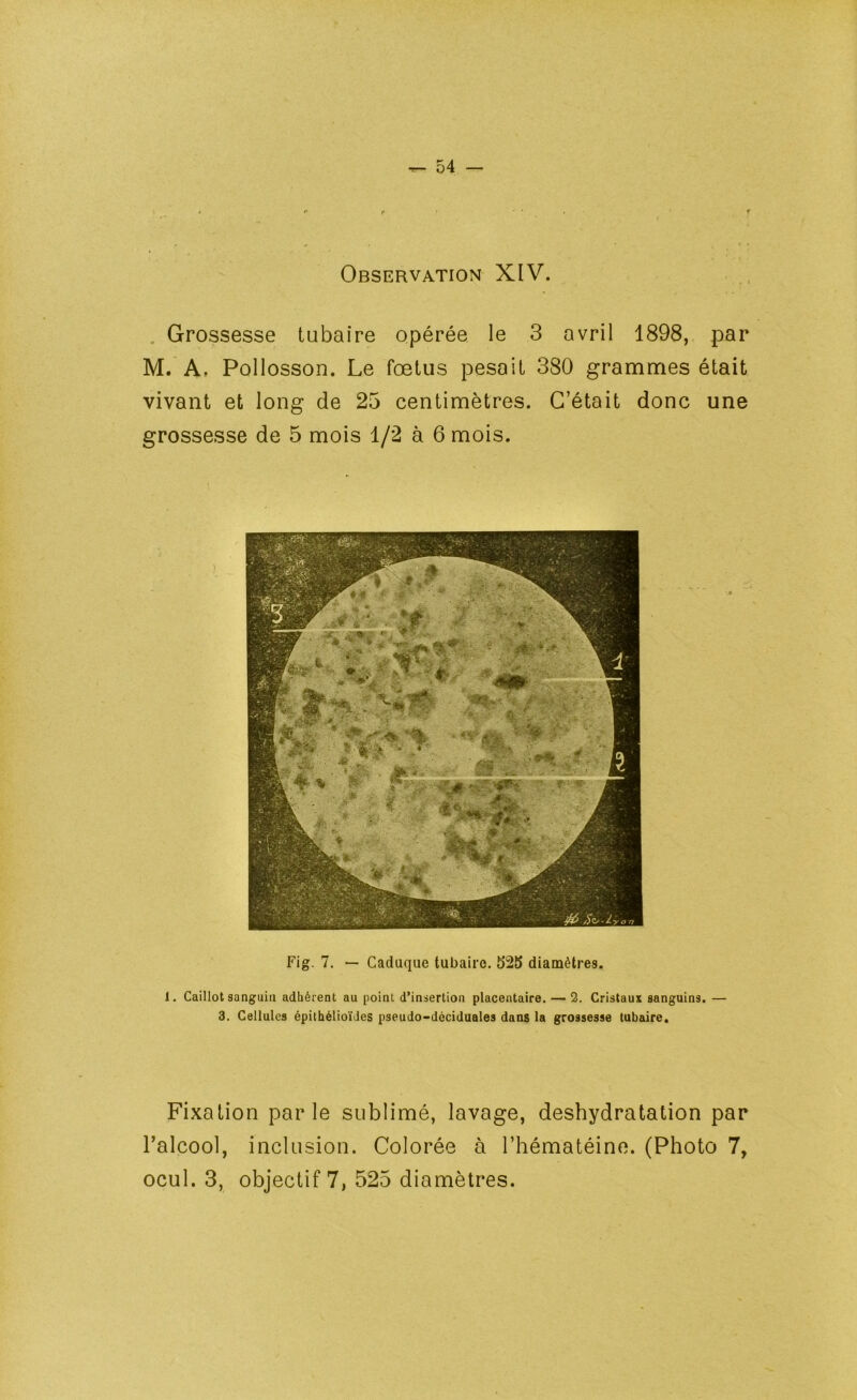 Observation XIV. . Grossesse tubaire opérée le 3 avril 1898, par M. A. Pollosson. Le fœtus pesait 380 grammes était vivant et long de 25 centimètres. C’était donc une grossesse de 5 mois 1/2 à 6 mois. Fig. 7. — Caduque tubaire. 525 diamètres. 1. Caillot sanguin adhérent au point d’insertion placentaire. — 2. Cristaux sanguins. — 3. Cellules épithélioïdes pseudo-déciduales dans la grossesse tubaire. Fixation parle sublimé, lavage, déshydratation par l’alcool, inclusion. Colorée à l’hématéine. (Photo 7, ocul. 3, objectif 7, 525 diamètres.