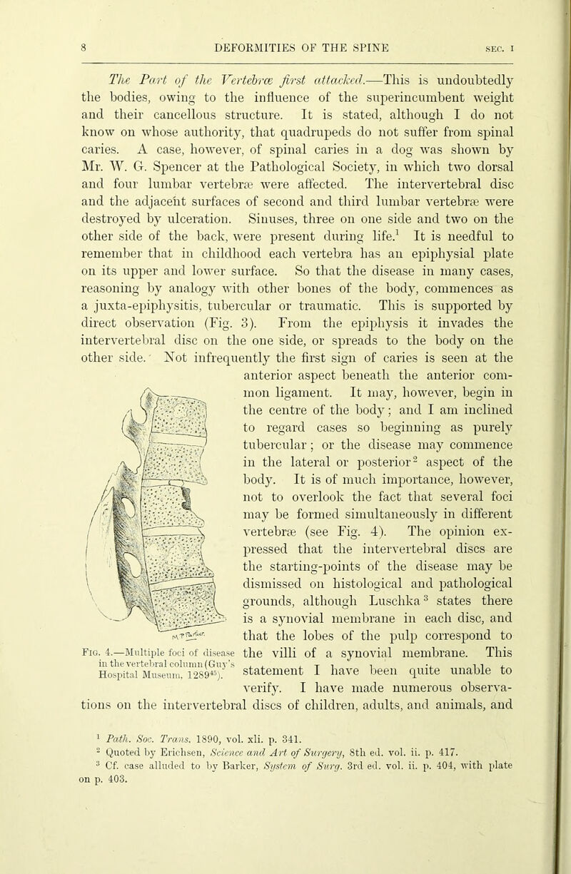 The Part of the Vertebrae first attached.—This is undoubtedly the bodies, owing to the influence of the superincumbent weight and their cancellous structure. It is stated, although I do not know on whose authority, that quadrupeds do not suffer from spinal caries. A case, however, of spinal caries in a dog was shown by Mr. W. G. Spencer at the Pathological Society, in which two dorsal and four lumbar vertebras were affected. The intervertebral disc and the adjacent surfaces of second and third lumbar vertebrae were destroyed by ulceration. Sinuses, three on one side and two on the other side of the back, were present during life.1 It is needful to remember that in childhood each vertebra has an epiphysial plate on its upper and lower surface. So that the disease in many cases, reasoning by analogy with other bones of the body, commences as a juxta-epiphysitis, tubercular or traumatic. This is supported by direct observation (Fig. 3). From the epiphysis it invades the intervertebral disc on the one side, or spreads to the body on the other side. Not infrequently the first sign of caries is seen at the anterior aspect beneath the anterior com- mon ligament. It may, however, begin in the centre of the body; and I am inclined to regard cases so beginning as purely tubercular; or the disease may commence in the lateral or posterior2 aspect of the body. It is of much importance, however, not to overlook the fact that several foci may be formed simultaneously in different vertebrae (see Fig. 4). The opinion ex- pressed that the intervertebral discs are the starting-points of the disease may be dismissed on histological and pathological grounds, although Luschka3 states there is a synovial membrane in each disc, and that the lobes of the pulp correspond to Fig. 4.—Multiple foci of disease the villi of a synovial membrane. This Hospital Museum. 128»«). statement I have been quite unable to verify. I have made numerous observa- tions on the intervertebral discs of children, adults, and animals, and 1 Path. Soc. Trans. 1890, vol. xli. p. 341. 2 Quoted by Eriehsen, Science and Art of Surgery, 8tli ed. vol. ii. p. 417. 3 Of. case alluded to by Barker, System of Surg. 3rd ed. vol. ii. p. 404, with plate on p. 403.