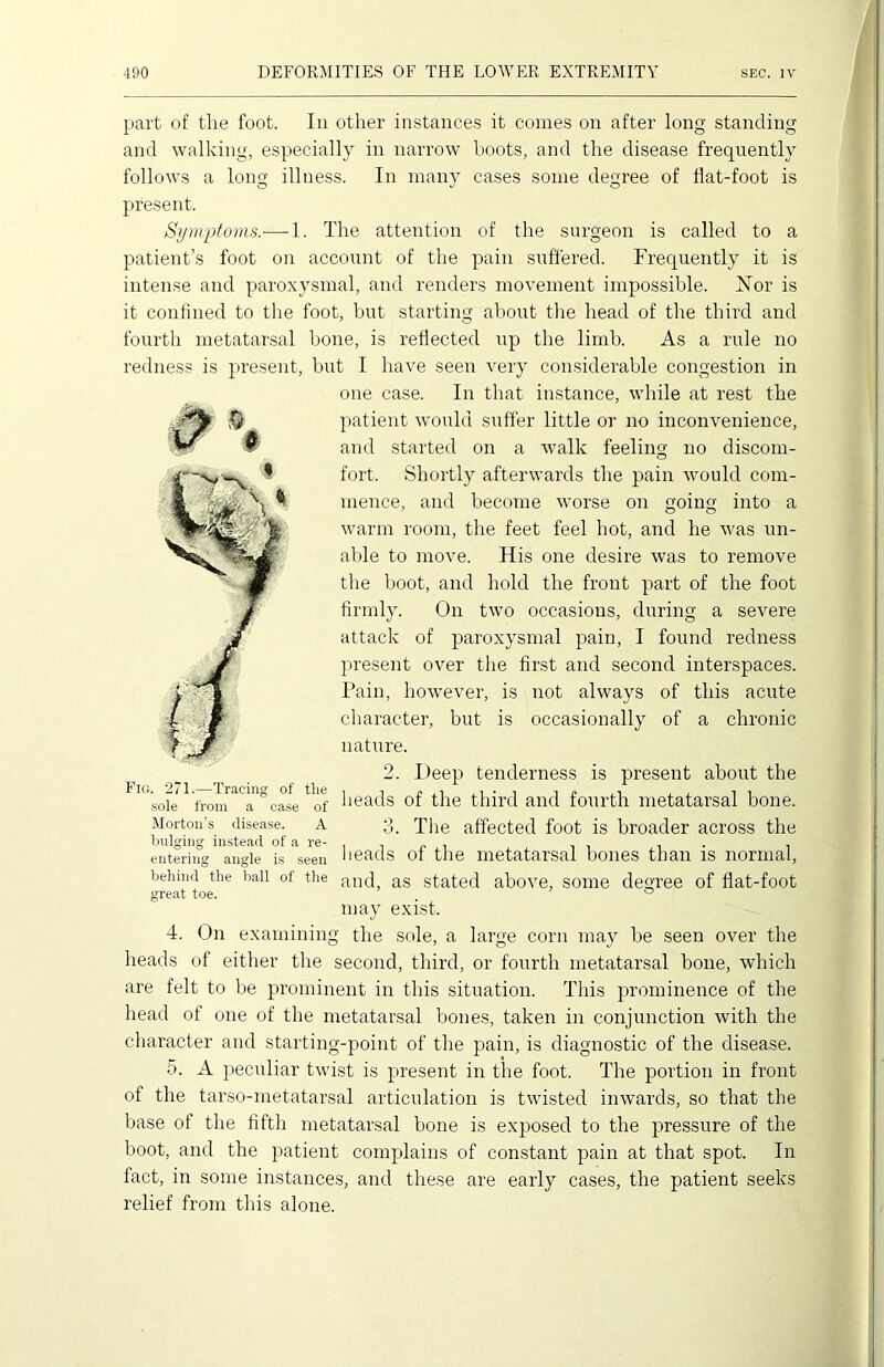 part of the foot. In other instances it comes on after long standing and walking, especially in narrow boots, and the disease frequently follows a long illness. In many cases some degree of flat-foot is present. Symptoms.— 1. The attention of the surgeon is called to a patient’s foot on account of the pain suffered. Frequently it is intense and paroxysmal, and renders movement impossible. Nor is it confined to the foot, but starting about the head of the third and fourth metatarsal bone, is reflected up the limb. As a rule no redness is present, but I have seen very considerable congestion in one case. In that instance, while at rest the patient would suffer little or no inconvenience, and started on a walk feeling no discom- fort. Shortly afterwards tire pain would com- mence, and become worse on going into a warm room, the feet feel hot, and he was un- able to move. His one desire was to remove the boot, and hold the front part of the foot firmly. On two occasions, during a severe attack of paroxysmal pain, I found redness present over the first and second interspaces. Pain, however, is not always of this acute character, but is occasionally of a chronic nature. 2. Deep tenderness is present about the ' sole fronfaCa,U°case of heads of the third and fourth metatarsal bone. Morton’s disease, a 3. The affected foot is broader across the bulging instead of a re- . , , , . , entering angle is seen heads of the metatarsal bones than is normal, behind the ball of the anc] as stated above, some degree of flat-foot great toe. ° may exist. 4. On examining the sole, a large corn may be seen over the heads of either the second, third, or fourth metatarsal bone, which are felt to be prominent in this situation. This prominence of the head of one of the metatarsal bones, taken in conjunction with the character and starting-point of the pain, is diagnostic of the disease. 5. A peculiar twist is present in the foot. The portion in front of the tarso-metatarsal articulation is twisted inwards, so that the base of the fifth metatarsal bone is exposed to the pressure of the boot, and the patient complains of constant pain at that spot. In fact, in some instances, and these are early cases, the patient seeks relief from this alone.