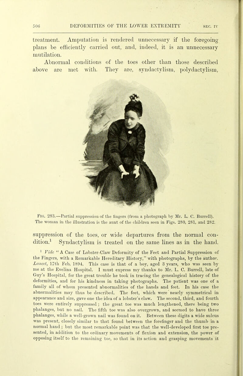 treatment. Amputation is rendered unnecessary if the foregoing- plans be efficiently carried out, and, indeed, it is an unnecessary mutilation. Abnormal conditions of the toes other than those described above are met with. They are, syndactylism, polydactylism, Fig. 283.—Partial suppression of tlie fingers (from a photograph by Mr. L. C. Burrell). The woman in the illustration is the aunt of the children seen in Figs. 280, 281, and 282. suppression of the toes, or wide departures from the normal con- dition.1 Syndactylism is treated on the same lines as in the hand. 1 Vide “A Case of Lobster-Claw Deformity of the Feet and Partial Suppression of the Fingers, with a Remarkable Hereditary History,” with photographs, by the author. Lancet, 17th Feb. 1894. This case is that of a boy, aged 3 years, who was seen by me at the Evelina Hospital. I must express my thanks to Mr. L. C. Burrell, late of Guy’s Hospital, for the great trouble he took in tracing the genealogical history of the deformities, and for his kindness in taking photographs. The patient was one of a family all of whom presented abnormalities of the hands and feet. In his case the abnormalities may thus be described. The feet, which were nearly symmetrical in appearance and size, gave one the idea of a lobster’s claw. The second, third, and fourth toes were entirely suppressed ; the great toe was much lengthened, there being two phalanges, but no nail. The fifth toe was also overgrown, and seemed to have three phalanges, while a well-grown nail was found on it. Between these digits a wide sulcus was present, closely similar to that found between the forefinger and the thumb in a normal hand ; but the most remarkable point was that the well-developed first toe pre- sented, in addition to the ordinary movements of flexion and extension, the power of opposing itself to the remaining toe, so that in its action and grasping movements it