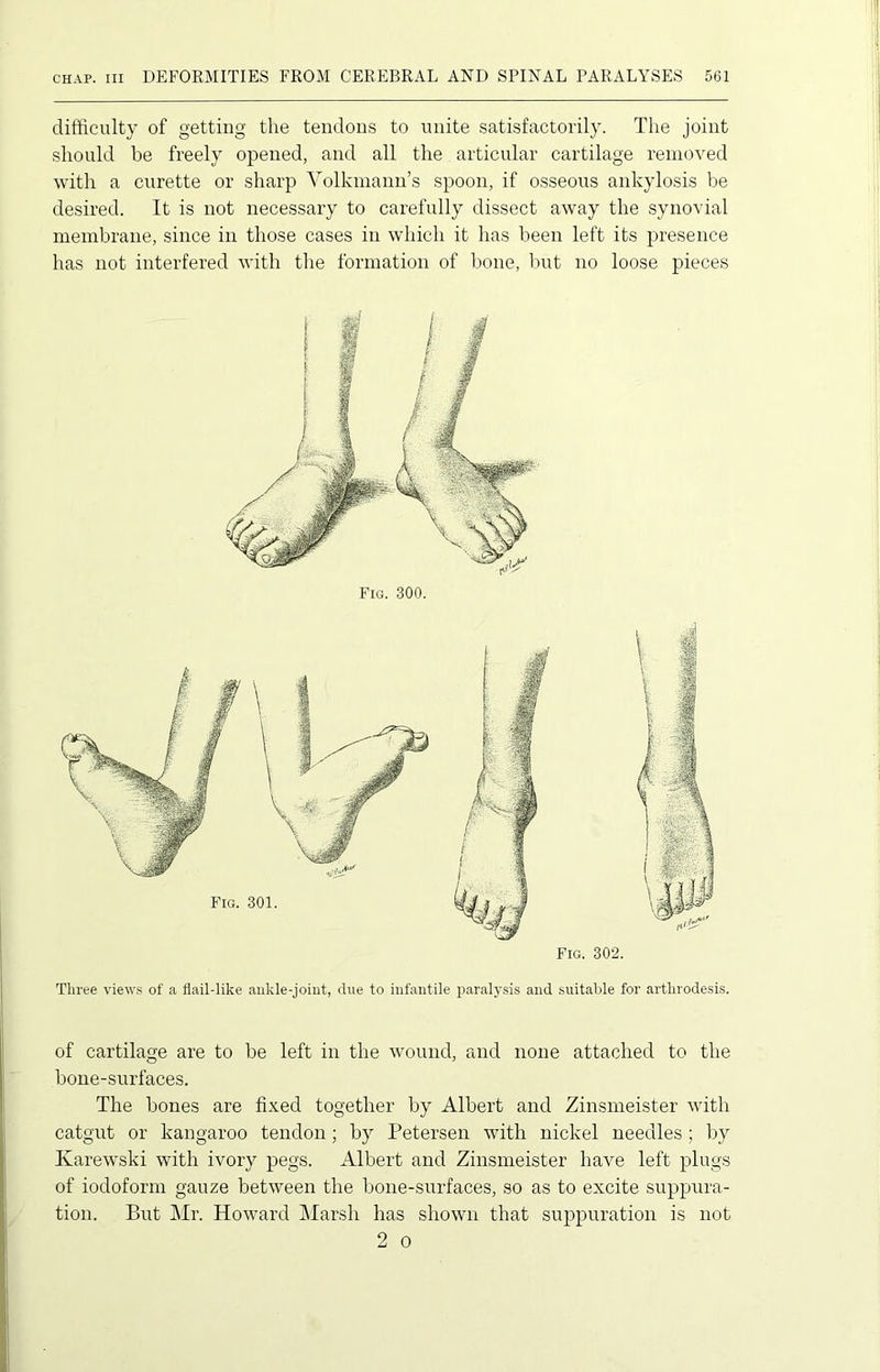 difficulty of getting the tendons to unite satisfactorily. The joint should be freely opened, and all the articular cartilage removed with a curette or sharp Volkmann’s spoon, if osseous ankylosis be desired. It is not necessary to carefully dissect away the synovial membrane, since in those cases in which it has been left its presence has not interfered with the formation of bone, but no loose pieces Fig. 300. Fig. 301. Three views of a flail-like ankle-joint, due to infantile paralysis and suitable for arthrodesis. of cartilage are to be left in the wound, and none attached to the bone-surfaces. The bones are fixed together by Albert and Zinsmeister with catgut or kangaroo tendon; by Petersen with nickel needles; by Karewski with ivory pegs. Albert and Zinsmeister have left plugs of iodoform gauze between the bone-surfaces, so as to excite suppura- tion. But Mr. Howard Marsh has shown that suppuration is not 2 o