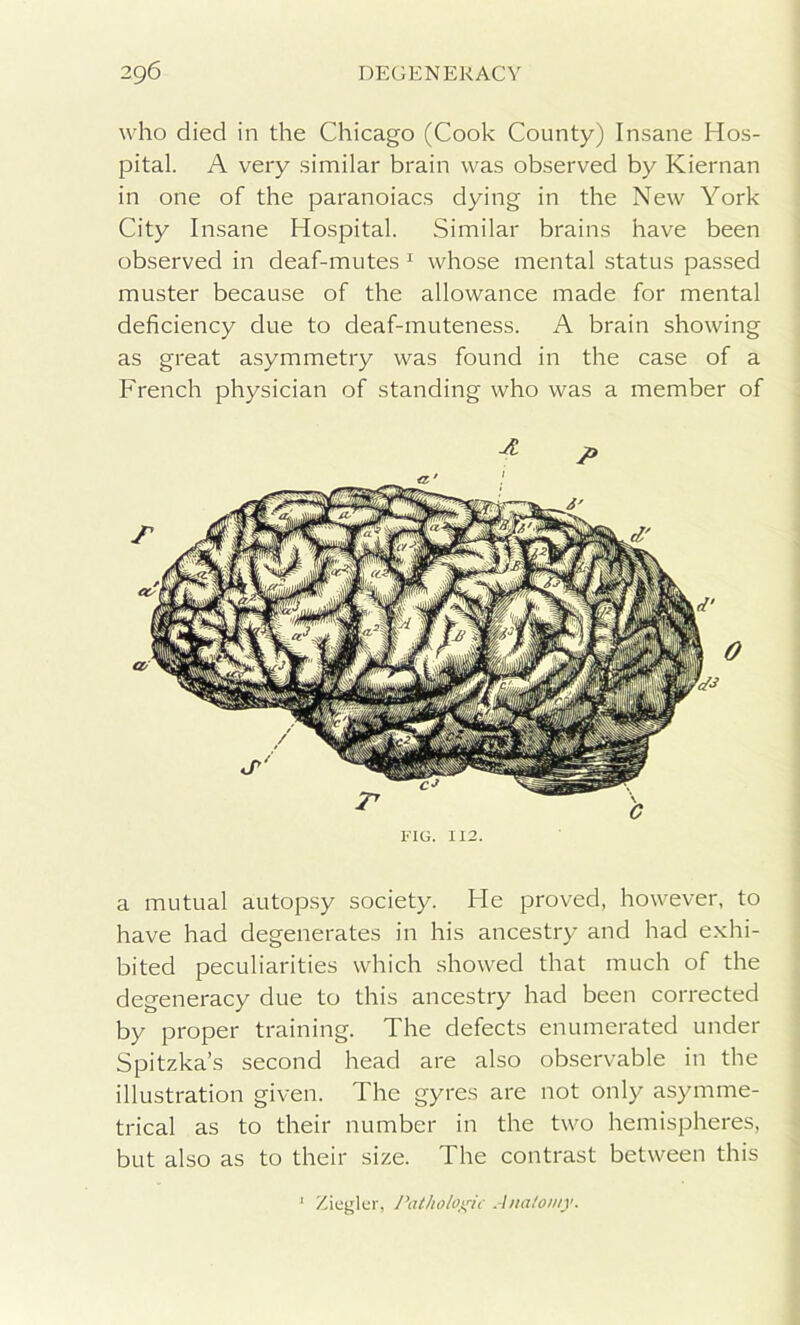 who died in the Chicago (Cook County) Insane Hos- pital. A very similar brain was observed by Kiernan in one of the paranoiacs dying in the New York City Insane Hospital. Similar brains have been observed in deaf-mutes 1 whose mental status passed muster because of the allowance made for mental deficiency due to deaf-muteness. A brain showing as great asymmetry was found in the case of a French physician of standing who was a member of fig. 112. a mutual autopsy society. He proved, however, to have had degenerates in his ancestry and had exhi- bited peculiarities which showed that much of the degeneracy due to this ancestry had been corrected by proper training. The defects enumerated under Spitzka’s second head are also observable in the illustration given. The gyres are not only asymme- trical as to their number in the two hemispheres, but also as to their size. The contrast between this Ziegkr, Pathologic Anatomy.