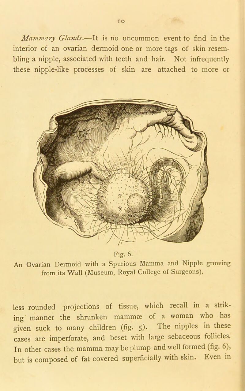 TO Manwiary Glands.—It is no uncommon event to find in the interior of an ovarian dermoid one or more tags of skin resem- bling a nipple, associated with teeth and hair. Not infrequently these nipple-like processes of skin are attached to more or Fig. 6. An Ovarian Deimoid with a Spurious Mamma and Nipple growing from its Wall (Museum, Royal College of Surgeons). less rounded projections of tissue, which recall in a strik- ing manner the shrunken mammae of a woman who has given suck to many children (fig. 5). The nipples in these cases are imperforate, and beset with large sebaceous follicles. In other cases the mamma may be plump and well formed (fig. 6), but is composed of fat covered superficially with skin. Even in