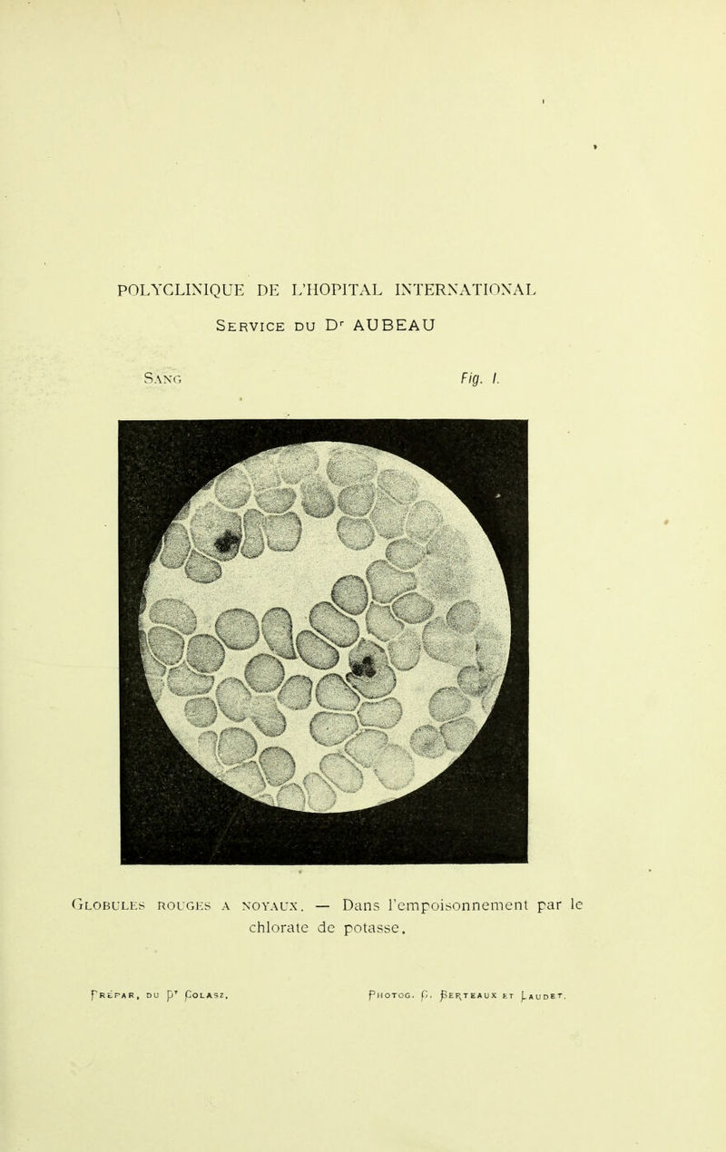 Service du D-- AUBEAU Sang Fig. I. Globules rouges a noyaux. — Dans l'empoisonnement par le chlorate de potasse.