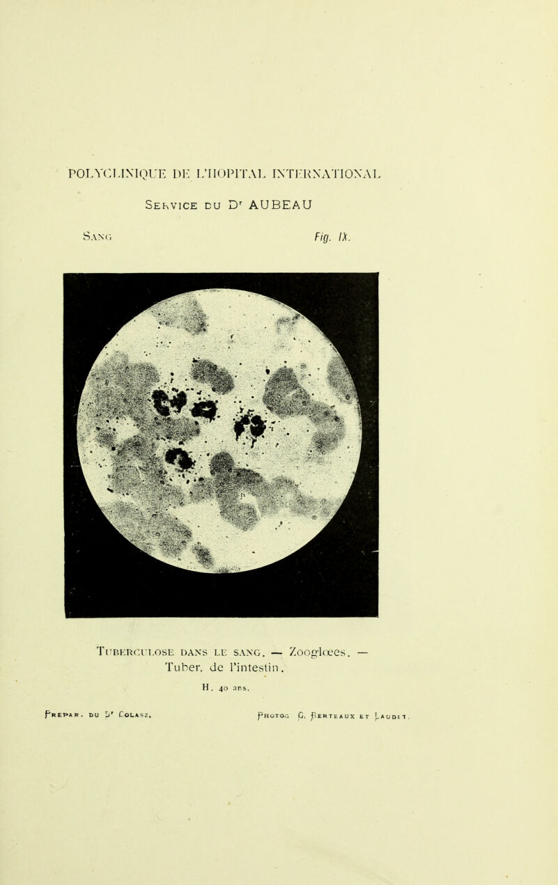Sekvice du AUBEAU Sang Ficj. IX. TUP.KRCULOSE DANS LE SANG. — ZoO^lœCS. — Tuber. de l'intestin. H. 40 ans.