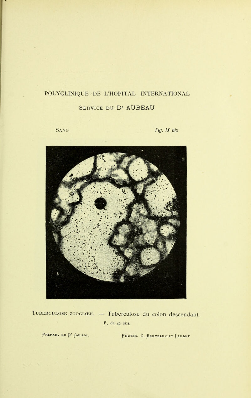 Service du AUBEAU Sang Fig. IX bis Tuberculose zooglœe. — Tuberculose du colon descendant. F. de 42 ans. PrÉPAR. du P' pOLASZ. f HOTOG. p. ;PERrEAUX ET ^AUDET