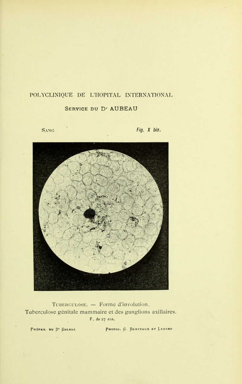 Service du D*^ AUBEAU Sang Fig. X bis. Tuberculose. — Forme d'involution. Tuberculose génitale mammaire et des ganglions axillaires. F. de 27 ans.