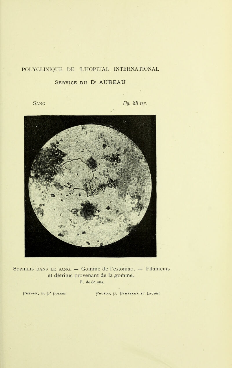 Service du AUBEAU Sang Fig. XII ter. Sï'PiiiLis DAiNS LE SANG. — GoiTime de l'esiomac. — Filaments et détritus provenant de la g-omme. F. de 60 ans.