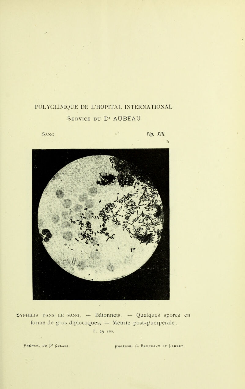 Service du AUBEAU Sang Fig. XIII. Syphilis dans li; sang. — Bâtonnets. — Quelques spores forme de ^^-ros diplocoques. — Métrite post-puerpérale. F. 25 ans.