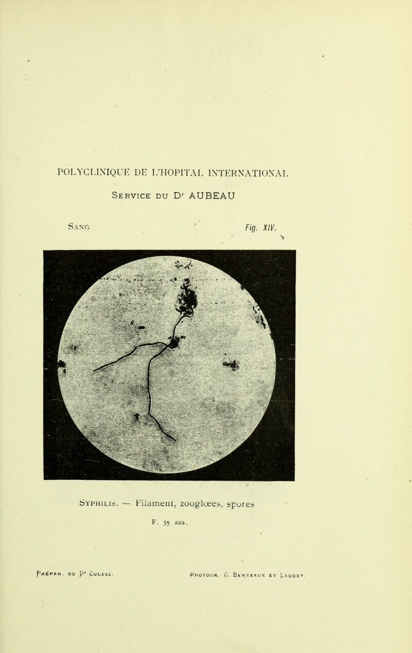 Service du AUBEAU Sang Fig. X!V. ^ Syphilis. — Filament, zooglœes, spores F. 35 ans.