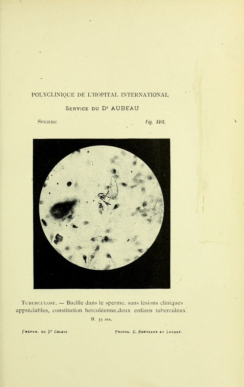 Service du D-^ AUBEAU Sperme Ficj. Tuberculose. — Bacille dans le sperme, sans lésions cliniques appréciables, constitution herculéenne,deux enfants tuberculeux'. H. 33 ans.