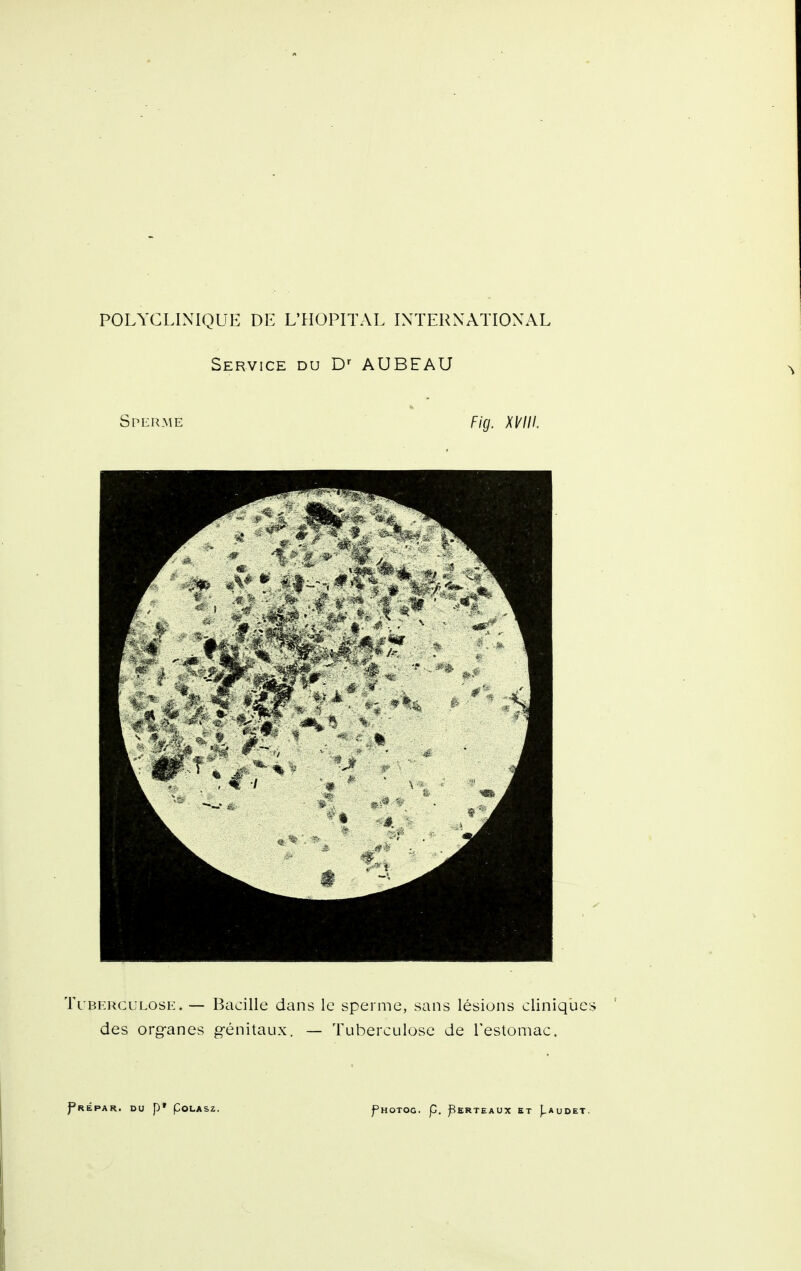 Service du D-- AUBEAU Sperme Fig. Xl^lll. Tuberculose. — Bacille dans le sperme, sans lésions cliniques des org-anes génitaux. — Tuberculose de l'estomac.