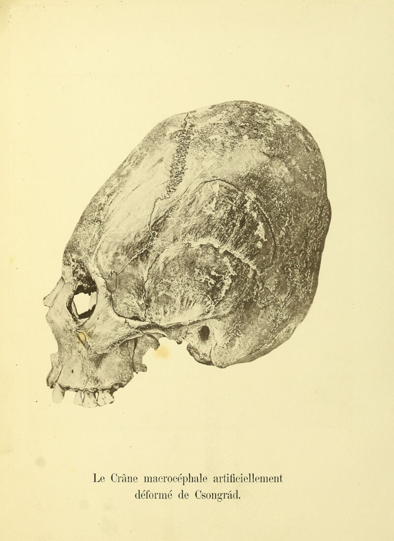 Le Crâne macroeépliale artificiellement déformé de Csongrâd.
