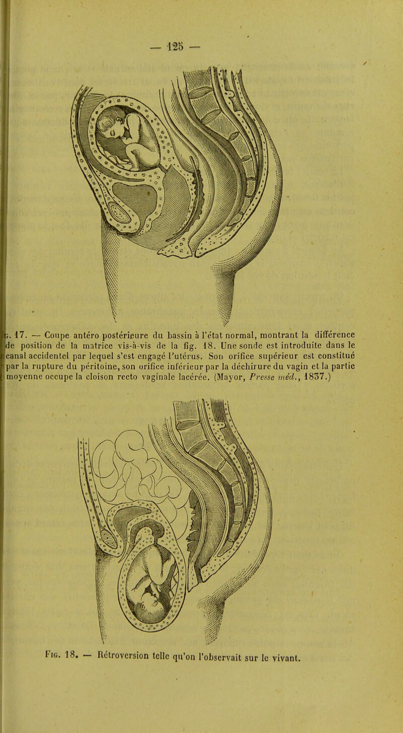 / j. 17. — Coupe antéro postérieure du bassin à l'état normal, montrant la différence de position de la matrice vis-à-vis de la fig. d8. Une sonde est introduite dans le canal accidentel par lequel s'est engagé l'utérus. Son orifice supérieur est constitué par la rupture du péritoine, son orifice inférieur par la déchirure du vagin et la partie moyenne occupe la cloison recto vaginale lacérée. (Mayor, Presse mëd., 1857.) Fig. 18. — Rétroversion telle qu'on l'observait sur le vivant.