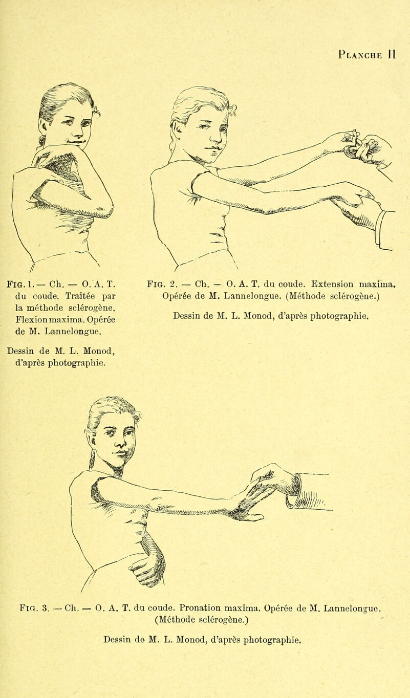 FiG.l.— Ch. — O. A. T. du coude. Traitée par la méthode sclérogène. Flexion maxima. Opérée de M. Lannelongue. Dessin de M. L. Monod, d'après photographie. FiG. 2. — Ch. — O. A. T. du coude. Extension maxima. Opérée de M, Lannelongue. (Méthode sclérogène.) Dessin de M. L. Monod, d'après photographie. Fio. 3, — Ch. — O. A. T. du coude. Pronation maxima. Opérée de M. Lannelongue. (Méthode sclérogène.)