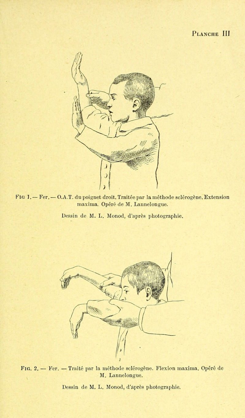 F'io 1. — Fer. — O.A.T. du poignet droit. Traitée par la méthode sclérogène. Extension masima. Opéré de M. Lannelongue.