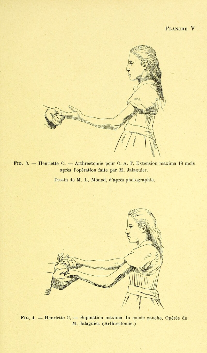 FiG. 3. — Henriette C. — Arthrectomie pour 0. A. ï. Extension maxima 18 mois après l'opération faite par M. Jalaguier. Dessin de M. L. Monod, d'après photographie. FiG. 4. — Henriette C. — Supination maxima du coude gauche. Opérée de