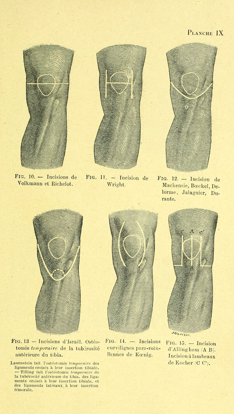 Fio. 10. — Incisions de Fig. ]). - Incision de Fia. ]2. — Incision de Voliinaann et Richelot. Wright. Mackensie, Bœckel, De- lorme, Jalaguier, Du- rante. antérieure du tibia. litnnes de Kœnig. Incision à lambeaux Lauenstcin fuit l'ostéotninic innpondrc des de Kocher iC C'j. ligaments croises il leur insertion tibiale. — Tilliug fait l'ostéotomie (''inporairi' de la tubérosité ante'rieure du tibia, des liga- ments croisés à leur Insertion tibiale, et des ligaments late'raux_ à leur iusertiou fémorale.