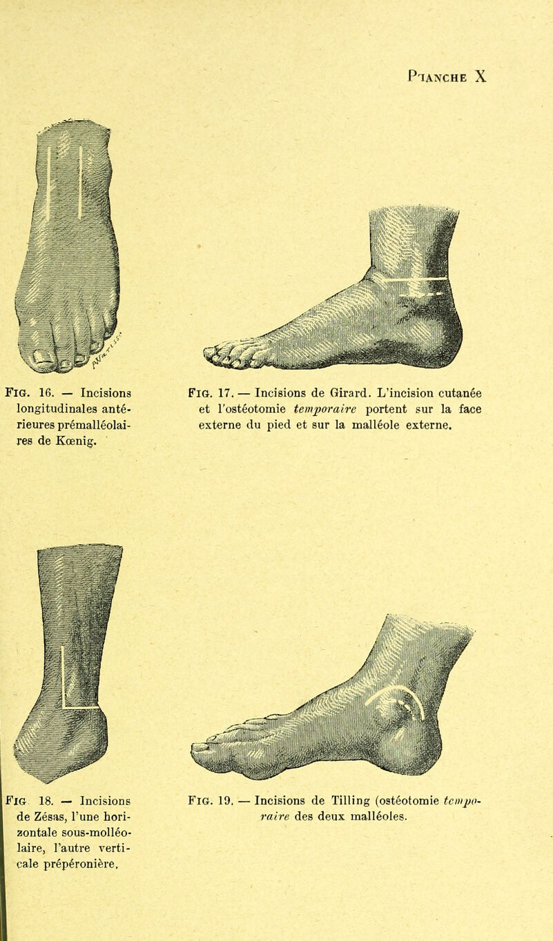 FiG 18. — Incisions Fig. 19. — Incisions de Tilling (ostéotomie tcmpo- de Zésas, l'une hori- raire des deux malléoles, zontale sous-molléo- laire, l'autre verti- cale prêpéronière.