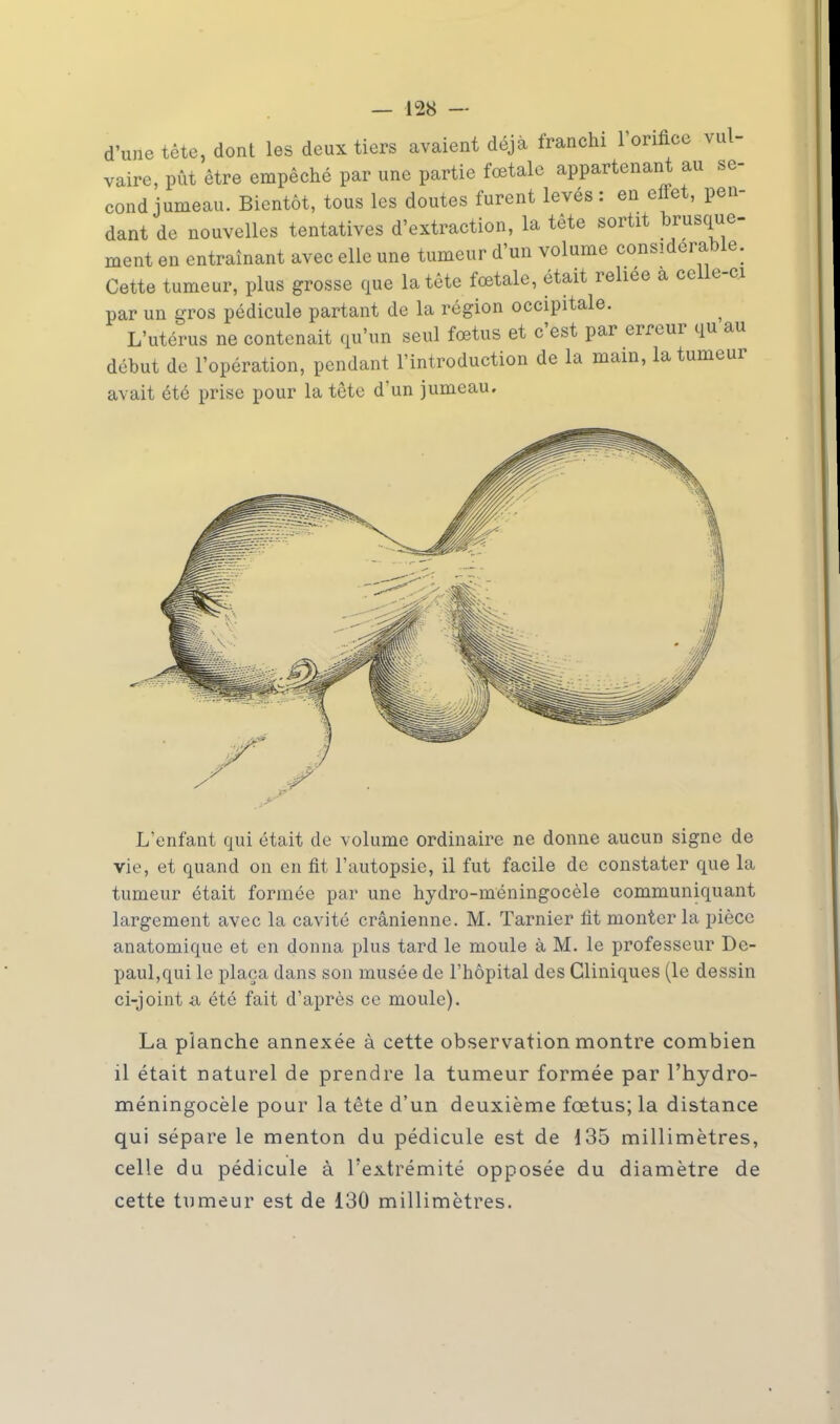 d'une tête, dont les deux tiers avaient déjà franchi l'orifice vul- vaire, pût être empêché par une partie fœtale appartenant au se- cond jumeau. Bientôt, tous les doutes furent levés : en effet, pen- dant de nouvelles tentatives d'extraction, la tête sortit brusque- ment en entraînant avec elle une tumeur d'un volume considérable. Cette tumeur, plus grosse que la tête fœtale, était reliée a celle-ci par un gros pédicule partant de la région occipitale. L'utérus ne contenait qu'un seul fœtus et c'est par erreur qu au début de l'opération, pendant l'introduction de la main, la tumeur avait été prise pour la tête d'un jumeau. L'enfant qui était de volume ordinaire ne donne aucun signe de vie, et quand on en fit l'autopsie, il fut facile de constater que la tumeur était formée par une hydro-méningocèle communiquant largement avec la cavité crânienne. M. Tarnier fit monter la pièce anatoniiquc et en donna plus tard le moule à M. le professeur De- paul,qui le plaça dans son musée de l'hôpital des Cliniques (le dessin ci-joint <i été fait d'après ce moule). La planche annexée à cette observation montre combien il était naturel de prendre la tumeur formée par l'hydro- méningocèle pour la tête d'un deuxième fœtus; la distance qui sépare le menton du pédicule est de 135 millimètres, celle du pédicule à l'extrémité opposée du diamètre de cette tumeur est de 130 millimètres.