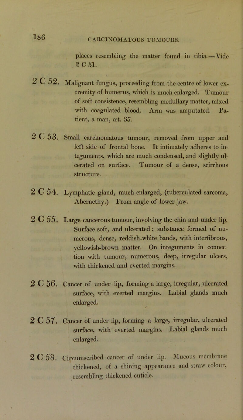 places resembling the matter found in tibia.—Vide 2 C 51. 2 C 52. Malignant fungus, proceeding from the centre of lower ex- tremity of humerus, which is much enlarged. Tumour of soft consistence, resembling medullary matter, mixed with coagulated blood. Arm was amputated. Pa- tient, a man, ast. 35. 2 C 53. Small carcinomatous tumoui-, removed from upper and left side of frontal bone. It intimately adheres to in- teguments, which are much condensed, and slightly ul- cerated on surface. Tumour of a dense, scirrhous structure. 2 C 54. Lymphatic gland, much enlarged, (tuberculated sarcoma, Abernethy.) From angle of lower jaw. 2 C 55. Large cancerous tumour, involving the chin and under lip. Surface soft, and ulcerated; substance formed of nu- merous, dense, reddish-white bands, with interfibrous, yellowish-brown matter. On integuments in connec- tion with tumour, numerous, deep, irregular ulcers, with thickened and everted margins. 2 C 56. Cancer of under lip, forming a large, irregular, ulcerated surface, with everted margins. Labial glands much enlarged. 2 C 57. Cancer of under lip, forming a large, irregular, ulcerated surface, with everted margins. Labial glands much enlarged. 2 C 58, (!iicumscribed cancer of under lip. iMucous membrane thickened, of a shining appearance and straw colour, resembling thickened cuticle.