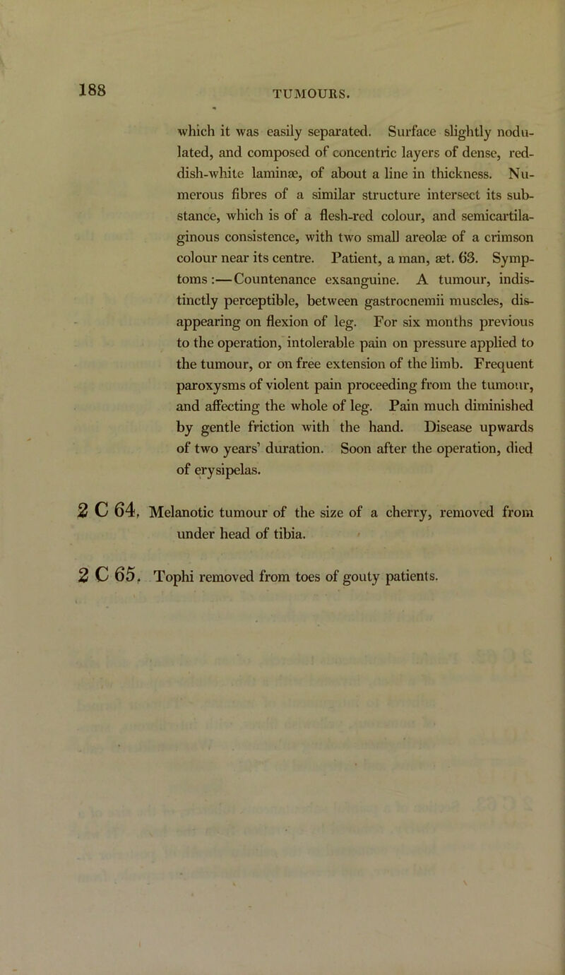 TUMOURS. which it was easily separated. Surface slightly nodu- lated, and composed of concentric layers of dense, red- dish-white laminae, of about a line in thickness. Nu- merous fibres of a similar structure intersect its sub- stance, which is of a flesh-red colour, and semicartila- ginous consistence, with two small areolae of a crimson colour near its centre. Patient, a man, aet. 63. Symp- toms :—Countenance exsanguine. A tumour, indis- tinctly perceptible, between gastrocnemii muscles, dis- appearing on flexion of leg. For six months previous to the operation, intolerable pain on pressure applied to the tumour, or on free extension of the limb. Frequent paroxysms of violent pain proceeding from the tumour, and affecting the whole of leg. Pain much diminished by gentle friction with the hand. Disease upwards of two years’ duration. Soon after the operation, died of erysipelas. 2 C 64, Melanotic tumour of the size of a cherry, removed from under head of tibia. 2 C 65, Tophi removed from toes of gouty patients.