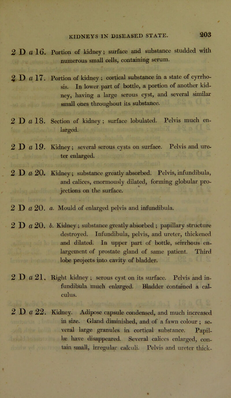 2 D fl 16. ^ D «17. 2 D a 18. 2 D a 19. 2 D «20. 2 D «20. 2 D o20. 2 D a21. 2 D « 22. Portion of kidney; surface and substance studded with numerous small cells, containing serum. Portion of kidney ; cortical substance in a state of cyrrho- sis. In lower part of bottle, a portion of another kid- ney, having a large serous cyst, and several similar small ones throughout its substance. Section of kidney ; surface lobulated. Pelvis much en- larged. / Kidney; several serous cysts on surface. Pelvis and ure- ter enlarged. Kidney; substance greatly absorbed. Pelvis, infundibula, and calices, enormously dilated, forming globular pro- jections on the surface. a. Mould of enlarged pelvis and infundibula, b. Kidney; substance greatly abk>rbed ; papillary structure destroyed. Infundibula, pelvis, and ureter, thickened and dilated. In upper part of bottle, scirrhous en- largement of prostate gland of same patient. Third lobe projects into cavity of bladder. Right kidney ; serous cyst on its surface. Pelvis and in- fundibula much enlarged. Bladder contained a cal- culus. Kidney. Adipose capsule condensed, and much increased in size. Gland diminished, and of a fawn colour ; se- veral large granules in cortical substance. Papil- lae have disappeared. Several calices enlarged, con- tain small, irregular calculi. Pelvis and ureter thick-