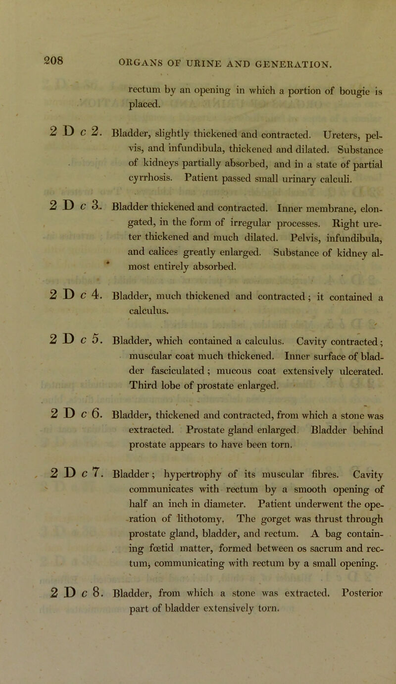 rectum by an opening in which a portion of bougie is placed. 2 D C 2. Bladder, slightly thickened and contracted. Ureters, pel- vis, and infundibula, thickened and dilated. Substance of kidneys partially absorbed, and in a state of partial cyrrhosis. Patient passed small urinary calculi. 2 D 6 3. Bladder thickened and contracted. Inner membrane, elon- gated, in the form of irregular processes. Right ure- ter tliickened and much dilated. Pelvis, infundibula, and calices greatly enlarged. Substance of kidney al- most entirely absorbed. 2 D g4. Bladder, much thickened and contracted; it contained a calculus. 2 D c 5. Bladder, which contained a calculus. Cavity contracted; muscular coat much thickened. Inner surface of blad- der fasciculated; mucous coat extensively ulcerated. Third lobe of prostate enlarged. 2 D c6. Bladder, thickened and contracted, from which a stone was extracted. Prostate gland enlarged. Bladder behind prostate appears to have been torn. 2T> c7. Bladder; hypertrophy of its muscular fibres. Cavity communicates with rectum by a smooth opening of half an inch in diameter. Patient underwent the ope- -ration of lithotomy, The gorget was thrust through prostate gland, bladder, and rectum. A bag contain- ing foetid matter, formed between os sacrum and rec- tunij communicating with rectum by a small opening. 2 D c 8. Bladder, from which a stone was extracted. Posterior part of bladder extensively torn.