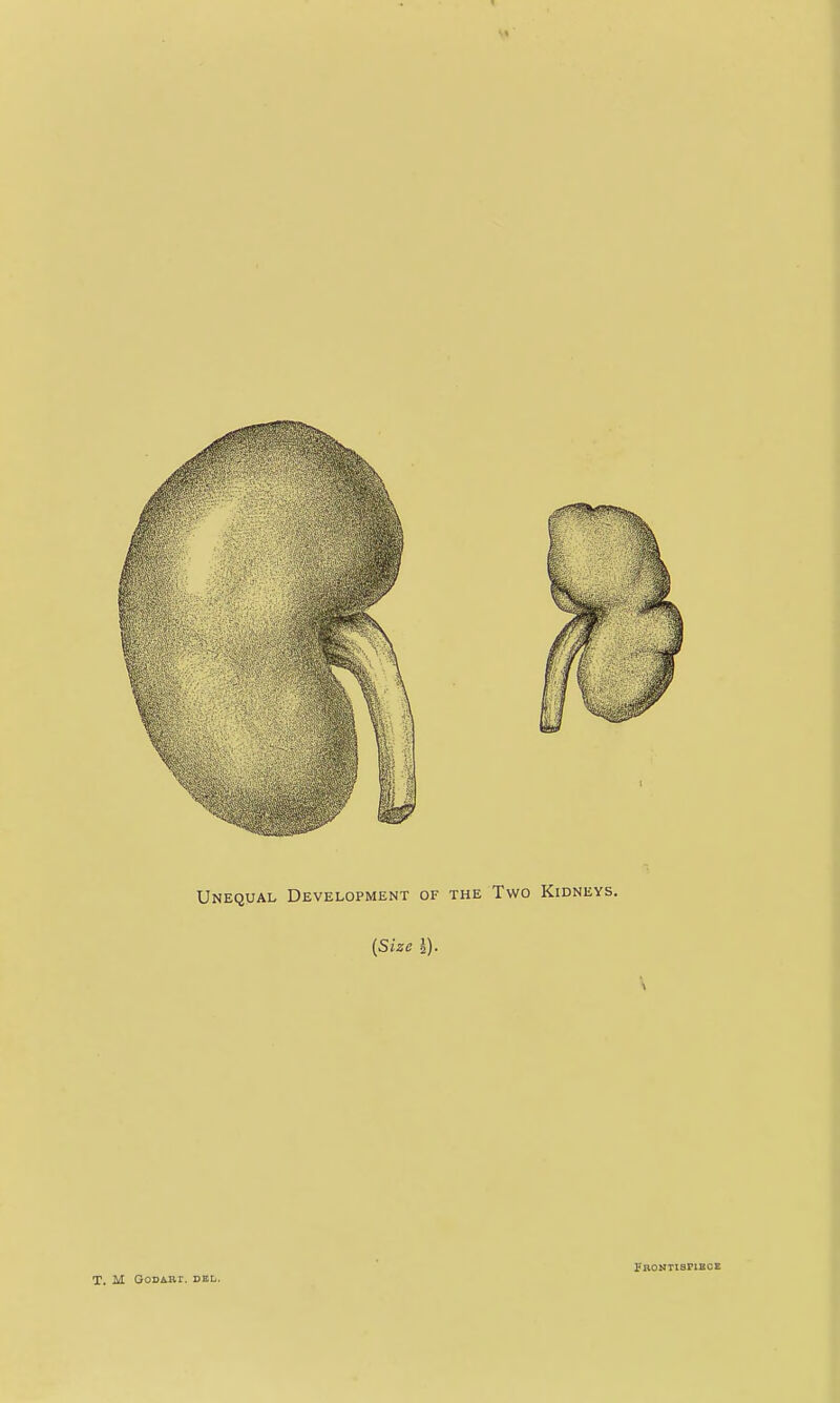 Unequal Development of the Two Kidneys. {Size I). \ M GODART. DEL. PRONTISPIHCE