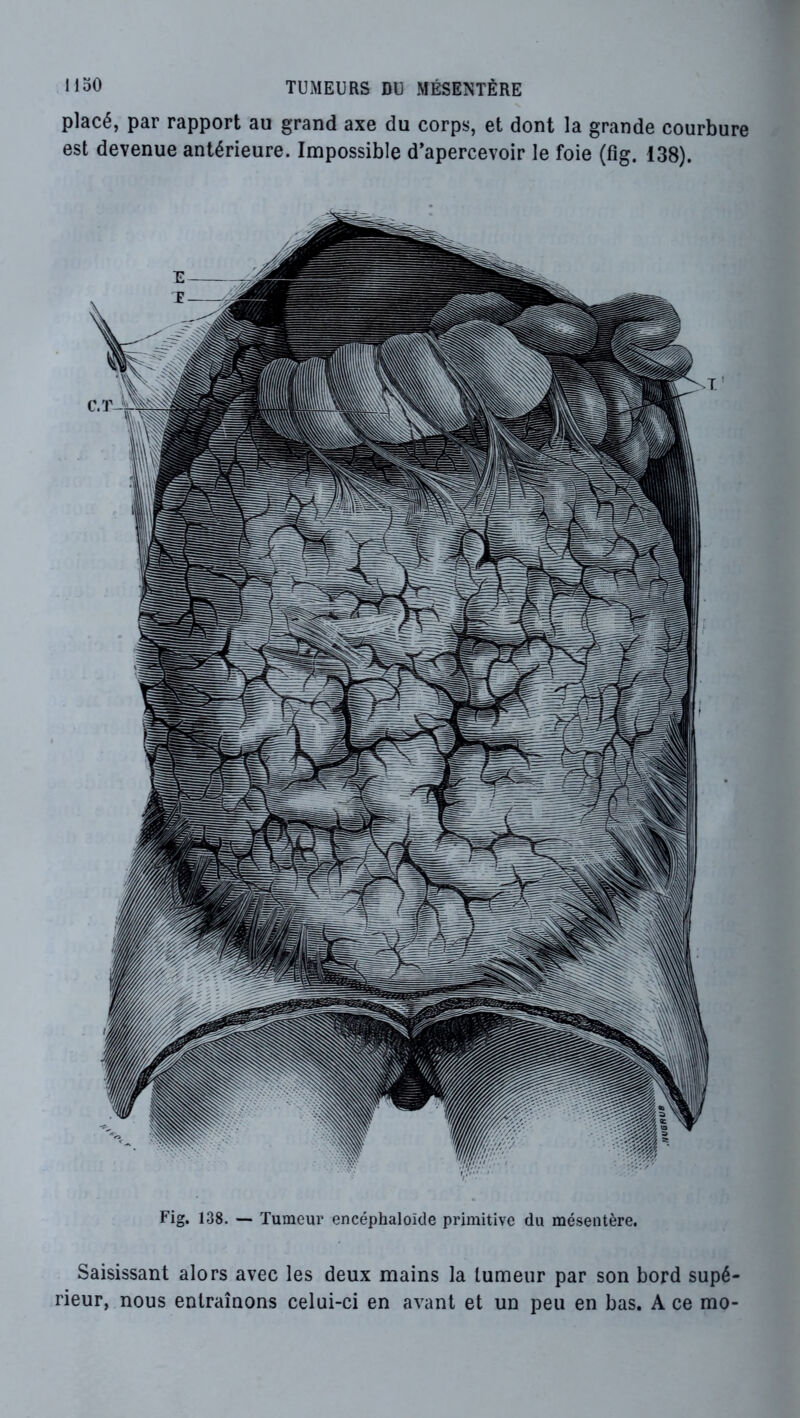 placé, par rapport au grand axe du corps, et dont la grande courbure est devenue antérieure. Impossible d’apercevoir le foie (fig. 138). Fig. 138. — Tumeur encéphaloïde primitive du mésentère. Saisissant alors avec les deux mains la tumeur par son bord supé- rieur, nous entraînons celui-ci en avant et un peu en bas. A ce mo-