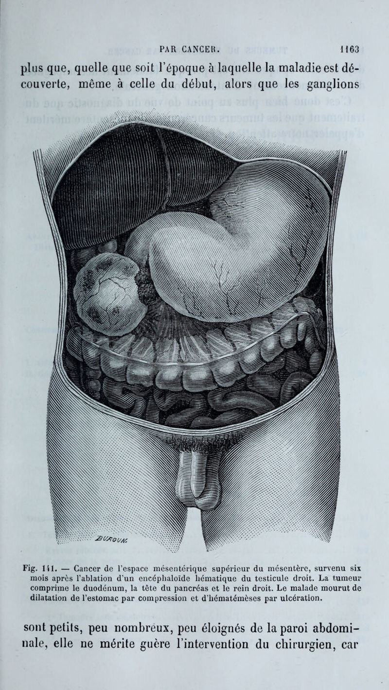 plus que, quelle que soit l’époque à laquelle la maladie est dé- couverte, même à celle du début, alors que les ganglions Fig. 141. — Cancer de l’espace mésentérique supérieur du mésentère, survenu six mois après l’ablation d’un encéplialoïde hématique du testicule droit. La tumeur comprime le duodénum, la tête du pancréas et le rein droit. Le malade mourut de dilatation de l’estomac par compression et d’hématémèses par ulcération. sont petits, peu nombreux, peu éloignés de la paroi abdomi- nale, elle ne mérite guère l’intervention du chirurgien, car