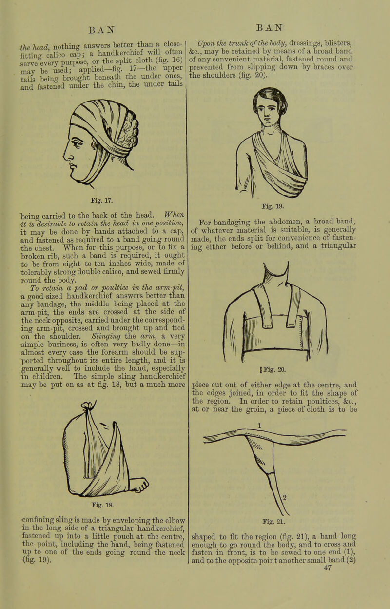 the head, nothing answers better than a, close- fitting calico cap; a handkerchief will often serve every purpose, or the split cloth (fig. 16) may be used; applied-fig. 17-the upper tails being brought beneath the under ones, and fastened under the chin, the under tails Upon the trunk of the body, dressings, blisters, &c., may be retained by means of a broad band of any convenient material, fastened round and prevented from slipping down by braces over the shoulders (fig. 20). Vig. 17. being carried to the back of the head. JFhen it is desirable to retain the head in one position, it may be done by bands attached to a cap, and fastened as required to a band going round the chest. When for this purpose, or to fix a broken rib, such a band is required, it ought to be from eight to ten inches wide, made of tolerably strong double calico, and sewed firmly round the body. To retain a pad or poultice in the arm-pit, a good-sized handkerchief answers better than any bandage, the middle being placed at the arm-pit, the ends are crossed at the side of the neck opposite, carried under the correspond- ing arm-pit, crossed and brought up and tied on the shoulder. Slinging the arm, a very simple business, is often very badly done—in almost every case the forearm should be sup- ported throughout its entire length, and it is generally well to include the hand, especially in children. The simple sling handkerchief may be put on as at fig. 18, but a much more Kg. 18. confining sling is made by enveloping the elbow in the long side of a triangular handkerchief, fastened up into a little pouch at the centre, the point, including the hand, being fastened up to one of the ends going round the neck Fig. 19. For bandaging the abdomen, a broad band, of whatever material is suitable, is generally made, the ends split for convenience of fasten- ing either before or behind, and a triangular I Fig. 20. piece cut out of either edge at the centre, and the edges joined, in order to fit the shape of the region. In order to retain poultices, &c., at or near the groin, a piece of cloth is to be Fig. 21. shaped to fit the region (fig. 21), a band long enough to go round the body, and to cross and fasten in front, is to be sewed to one end (1),