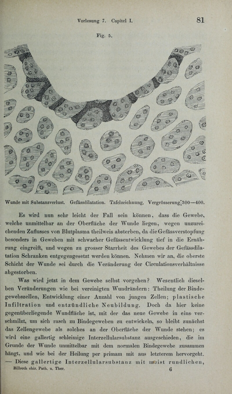 Fig. 5. Wunde mit Substanzverlust. Gefässdilatation. Tafel Zeichnung. Vergrösserung730O—400. Es wird nun sehr leicht der Fall sein können, dass die Gewebe, welche unmittelbar an der Oberfläche der Wunde liegen, wegen unzurei- chenden Zuflusses von Blutplasma theilweis absterben, da die Gefässverstopfung besonders in Geweben mit schwacher Gefässentwicklung tief in die Ernäh- rung eingreift, und wegen zu grosser Starrheit des Gewebes der Gefässdila- tation Schranken entgegengesetzt werden können. Nehmen wir an, die oberste Schicht der Wunde sei durch die Veränderung der Circulationsverhältnisse abgestorben. Was wird jetzt in dem Gewebe selbst vorgehen? Wesentlich diesel- ben Veränderungen wie bei vereinigten Wundrändern: Theilung der Binde- gewebszellen, Entwicklung einer Anzahl von jungen Zellen; plastische Infiltration und entzündliche Neubildung. Doch da hier keine gegenüberliegende Wundfläche ist, mit der das neue Gewebe in eins ver- schmilzt, um sich rasch zu Bindegeweben zu entwickeln, so bleibt zunächst das Zellengewebe als solches an der Oberfläche der Wunde stehen; es wird eine gallertig schleimige Interzellularsubstanz ausgeschieden, die im Grunde der Wunde unmittelbar mit dem normalen Bindegewebe zusammen hängt, und wie bei der Heilung per primam mit aus letzterem hervorgeht. -— Diese gallertige Interzellularsubstanz mit mraist rundlichen, Billroth chir. Path. u. Ther. 6