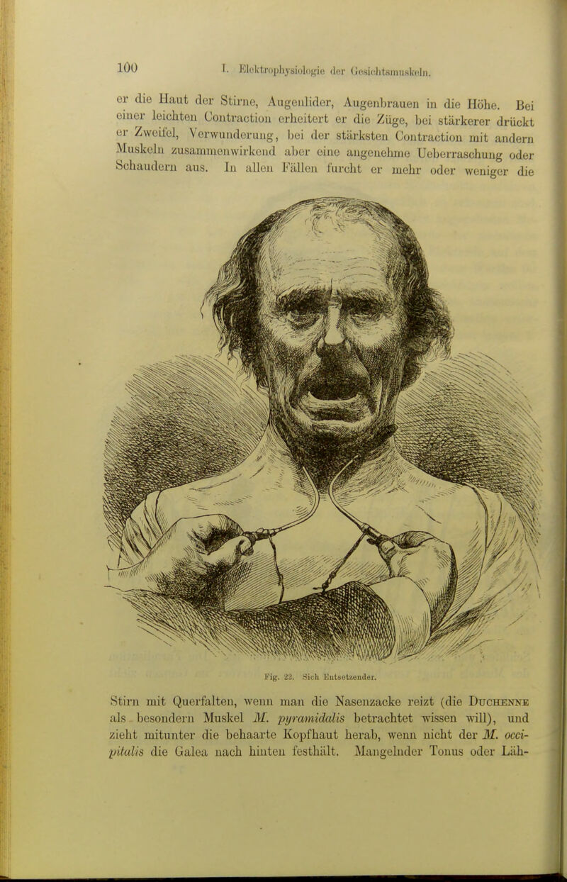 er die Haut der Stirne, Augenlider, Augenbrauen in die Höhe. Bei einer leichten Contraction erheitert er die Züge, bei stärkerer drückt er Zweifel, Verwunderung, bei der stärksten Contraction mit andern Muskeln zusammenwirkend aber eine angenehme Ueberraschung oder Schaudern aus. In allen Fällen furcht er mehr oder weniger die IMg. 22. Sich Entsetzender. Stirn mit Querfalten, wenn man die Nasenzacke reizt (die Duchenne als besondern Muskel M. pyramidalis betrachtet wissen will), und zieht mitunter die behaarte Kopfhaut herab, wenn nicht der 31. oeci- pitulis die Galea nach hinten festhält. Mangelnder Tonus oder Läh-