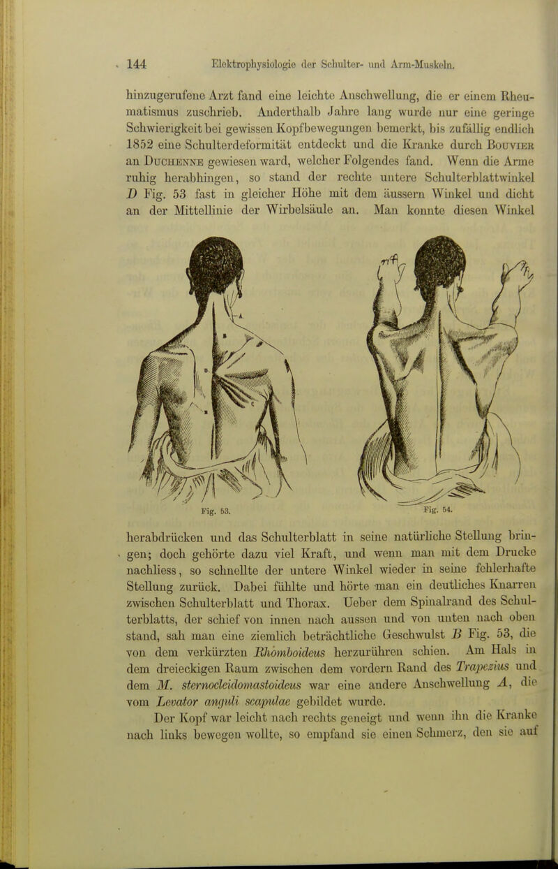 hinzugenifene Arzt fand eine leichte Anschwellung, die er einem Rheu- matismus 2;uschrieb. Anderthalb Jahre lang wurde nur eine geringe Scliwierigkeit hei gewissen Kopfbewegungen bemerkt, bis zufällig endlich 1852 eine Schulterdeformität entdeckt und die Kranke durch Boltvier an Duchenne gewiesen ward, welcher Folgendes fand. Wenn die Arme ruhig herabhingen, so stand der rechte untere Schulterblattwinkel D Fig. 53 fast in gleicher Höhe mit dem äussern Winkel und dicht an der Mittellinie der Wirbelsäule an. Man konnte diesen Winkel herabdrücken und das Schulterblatt in seine natürliche Stellung brin- gen; doch gehörte dazu viel Kraft, und wenn man mit dem Drucke nachliess, so schnellte der untere Winkel wieder in seine fehlerhafte Stellung zurück. Dabei fühlte und hörte man ein deutliches Knarren zwischen Schulterblatt und Thorax. Ueber dem Spinalrand des Schul- terblatts, der schief von innen nach aussen und von unten nach oben stand, sah man eine ziemlich beträchtliche Geschwulst B Fig. 53, die von dem verkürzten Rhomhoideus herzurühren schien. Am Hals in dem dreieckigen Raum zwischen dem vordem Rand des Trapezius und dem M. sternocleidomastoideus war eine andere Anschwellung A, die vom Levator angidi scapulae gebildet wurde. Der Kopf war leicht nach rechts geneigt und wenn ihn die Kranke nach links bewegen wollte, so empfand sie einen Schmerz, den sie auf